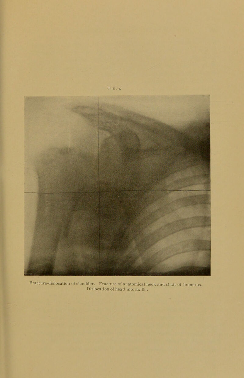 Fracture-dislocation of shoulder. Fracture of anatomical neck and shaft of humerus. Dislocation of head into axilla.