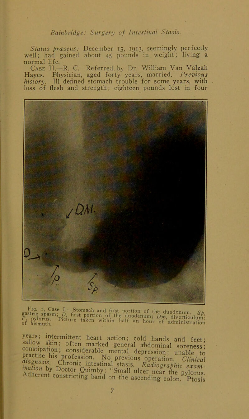Status preesens: December 15, 1913, seemingly perfectly well; had gained about 45 pounds in weight; living a normal life. Case II.—R. C. Referred by Dr. William Van Valzah Hayes. Physician, aged forty years, married. Previous history. Ill defined stomach trouble for some years, with loss of flesh and strength; eighteen pounds lost in four I-—Stomach and first portion of the duodenum Vh of ^Umuth.  administration sabnl’ heart action; cold hands and feet; consHna?’’ parked general abdominal soreness; Sse bT’ ‘^°siderable mental depression; unable to operation. Clinical ■ ' t^nroixic intcstina.1 stasis, ^ctdio^fQhJtir excitit inaHon by Doctor Quimby: “Small ulcer nef the Pvlor s Adherent constricting band on the ascending colon.Tosis