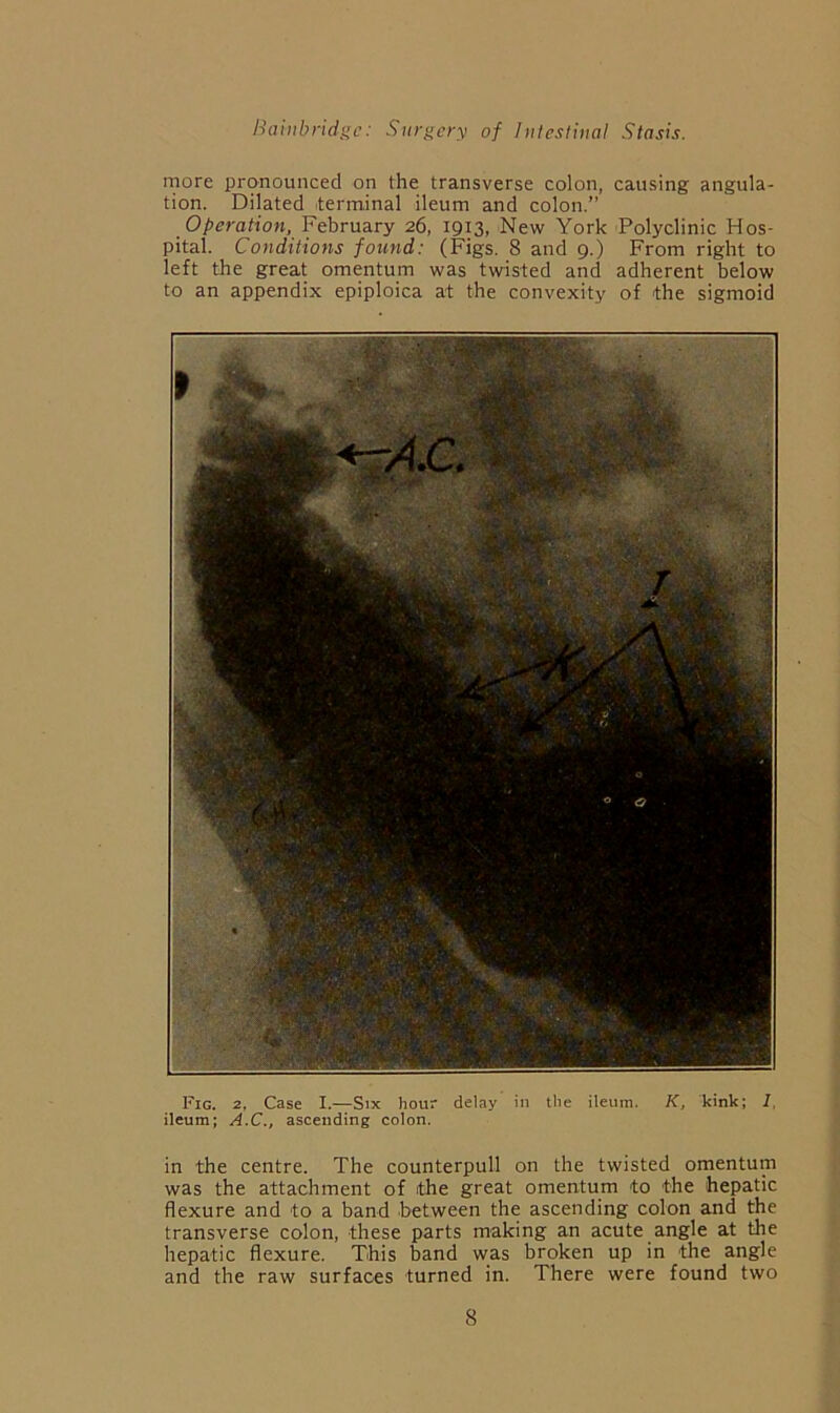 more pronounced on the transverse colon, causing angula- tion. Dilated terminal ileum and colon.” Operation, February 26, 1913, New York Polyclinic Hos- pital. Conditions found: (Figs. 8 and 9.) From right to left the great omentum was twisted and adherent below to an appendix epiploica at the convexity of the sigmoid Fig. 2, Case I.—Six hour delay in the ileum. K, kink; I. ileum; A.C., ascending colon. in the centre. The counterpull on the twisted omentum was the attachment of the great omentum to the hepatic flexure and to a band between the ascending colon and the transverse colon, these parts making an acute angle at the hepatic flexure. This band was broken up in the angle and the raw surfaces turned in. There were found two