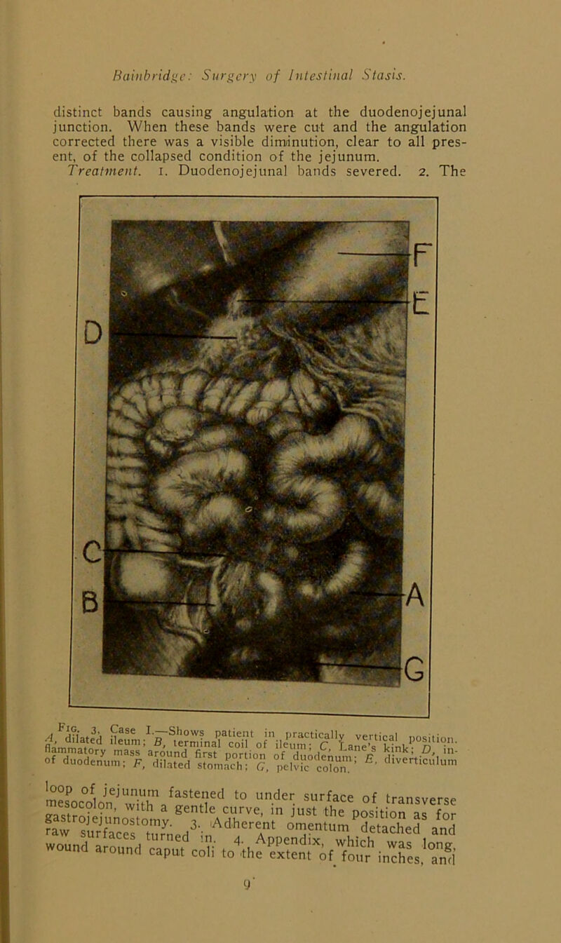 distinct bands causing angulation at the duodenojejunal junction. When these bands were cut and the angulation corrected there was a visible diminution, clear to all pres- ent, of the collapsed condition of the jejunum. Treatment, i. Duodenojejunal bands severed. 2. The ^ 'oop of jejunum fastened to under surface of transverse mesocolon, with a gentle curve, in just the position al for raw’^STc?f°tmneH^'- omentum detached and wound anonn'd ““f y'