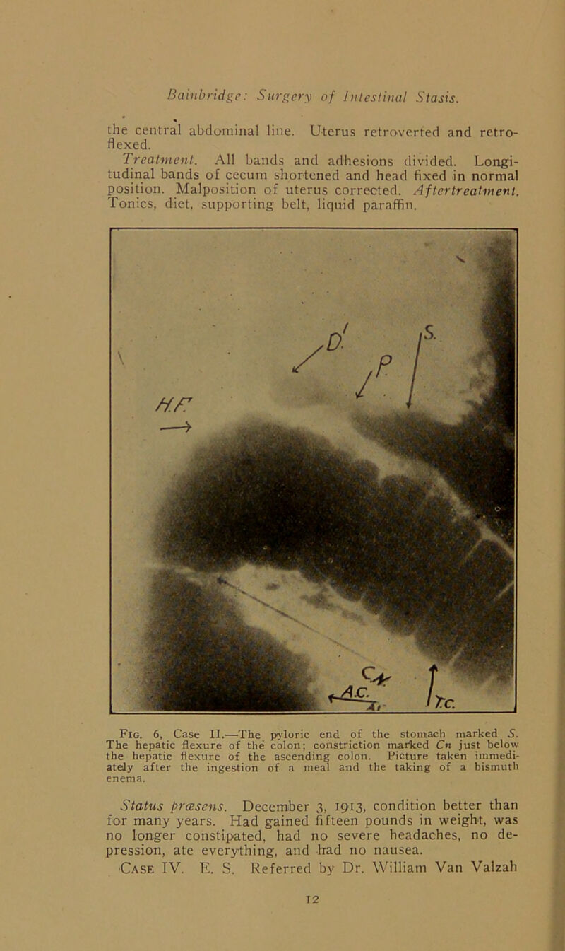 the central abdominal line. Uterus retroverfed and retro- rtexed. Treatment. All bands and adhesions divided. Longi- tudinal bands of cecum shortened and head fixed in normal position. Malposition of uterus corrected. Aftertreatment. Tonics, diet, supporting belt, liquid paraffin. Fig. 6, Case II.—The pj’loric end of the stomach marked 5. The hepatic flexure of the colon; constriction marked Cn just below the hepatic flexure of the ascending colon. Picture taken immedi- ately after the ingestion of a meal and the taking of a bismuth enema. Status prcBsens. December 3, 1913, condition better than for many years. Had gained fifteen pounds in weight, was no longer constipated, had no severe headaches, no de- pression, ate everything, and had no nausea. 'Case IV. E. S. Referred by Dr. William Van Valzah T2
