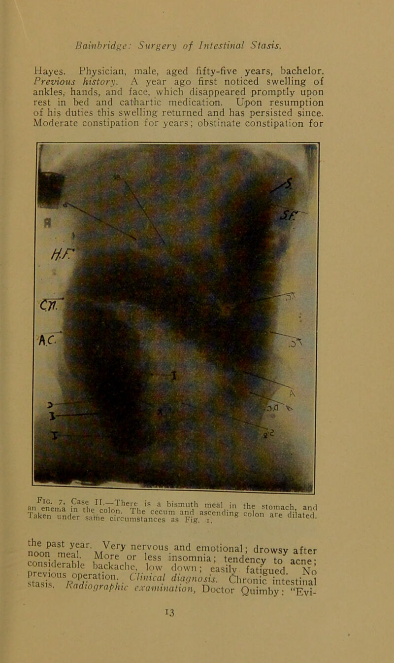 Hayes. Physician, male, aged fifty-five years, bachelor. Previous history. A year ago first noticed swelling of ankles, hands, and face, which disappeared promptly upon rest in bed and cathartic medication. Upon resumption of his duties this swelling returned and has persisted since. Moderate constipation for years; obstinate constipation for n --TIierc is a bismuth meal in the stomarh • colon. The cecum and ascendinir colon are di’lat Taken under same circumstances as Fig. , ^re ddat noormeai'''' My^''^ nervous and emotional; drowsy after oon mea, More or less insomnia; tendency to acne- nsiderable backache, low down; easily fatieued No (^^BPiosis. Chronic intestinal ■tasis. Radwgrafhic c.vamination, Doctor Quimby • “Evi-