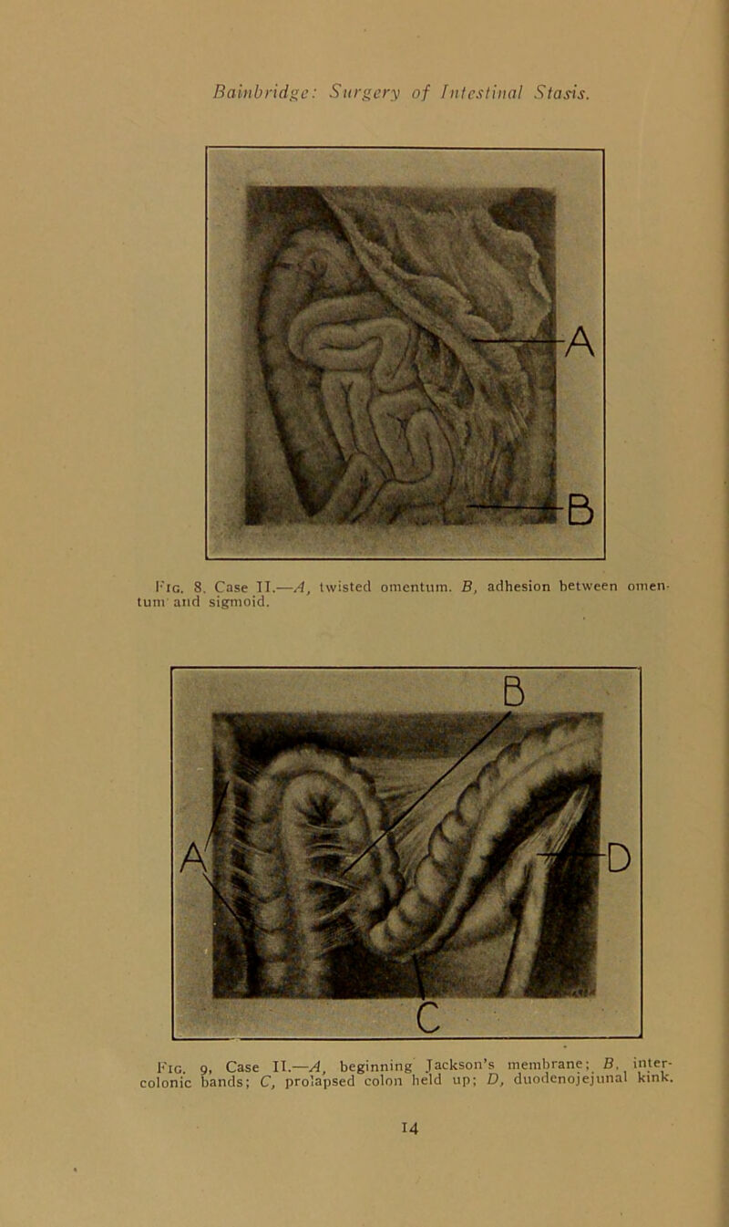 I'lG. 8. Case II.—A, twisted omentum. B, adhesion between omen- tum and sigmoid. Kic. 9, Case II.—A, beginning Jaekson’s membrane; B. inter- eolonic bands; C, prolapsed colon held up; D, duodenojejunal kink.