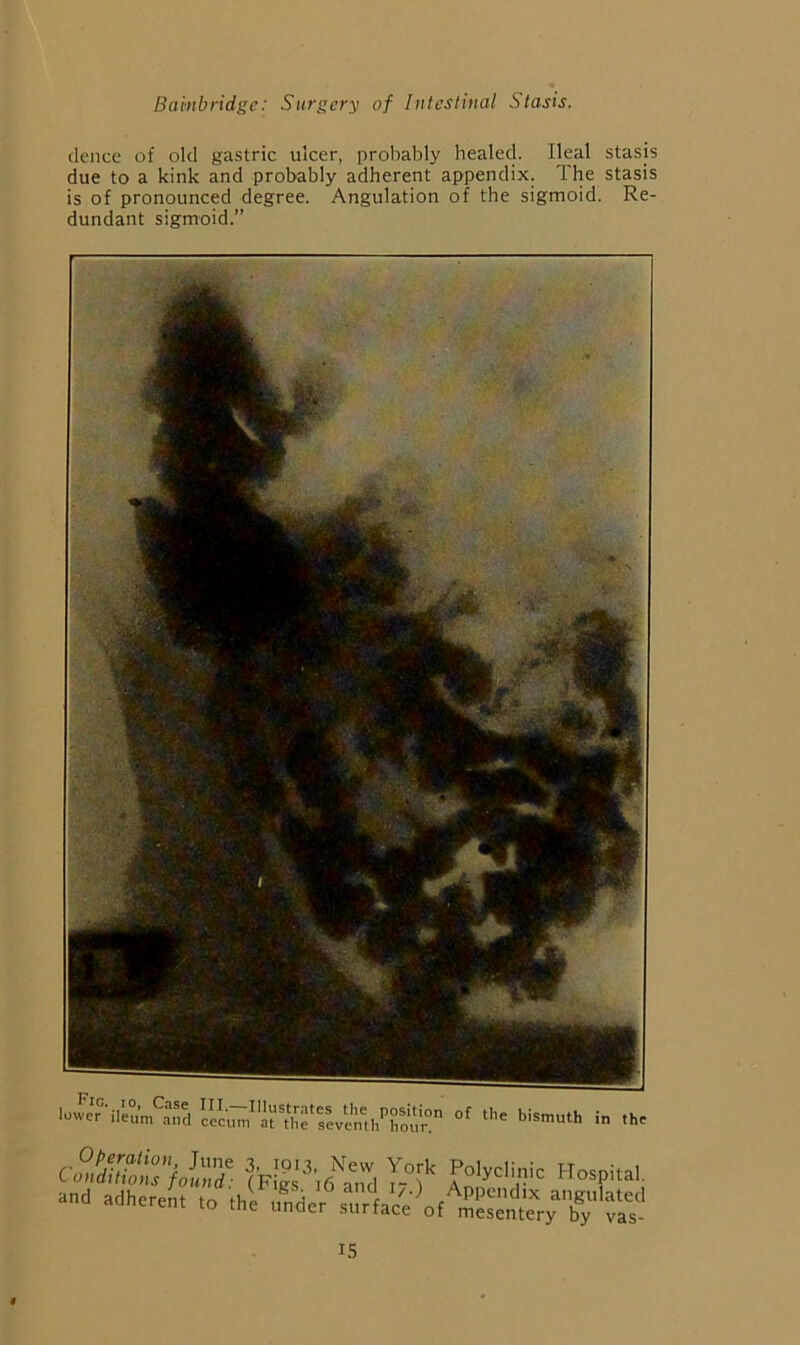 deuce of old gastric ulcer, probably healed. Ileal stasjs due to a kink and probably adherent appendix. The stasis is of pronounced degree. Angulation of the sigmoid. Re- dundant sigmoid.” and adherent to the under surfaced mSntTryT, v£