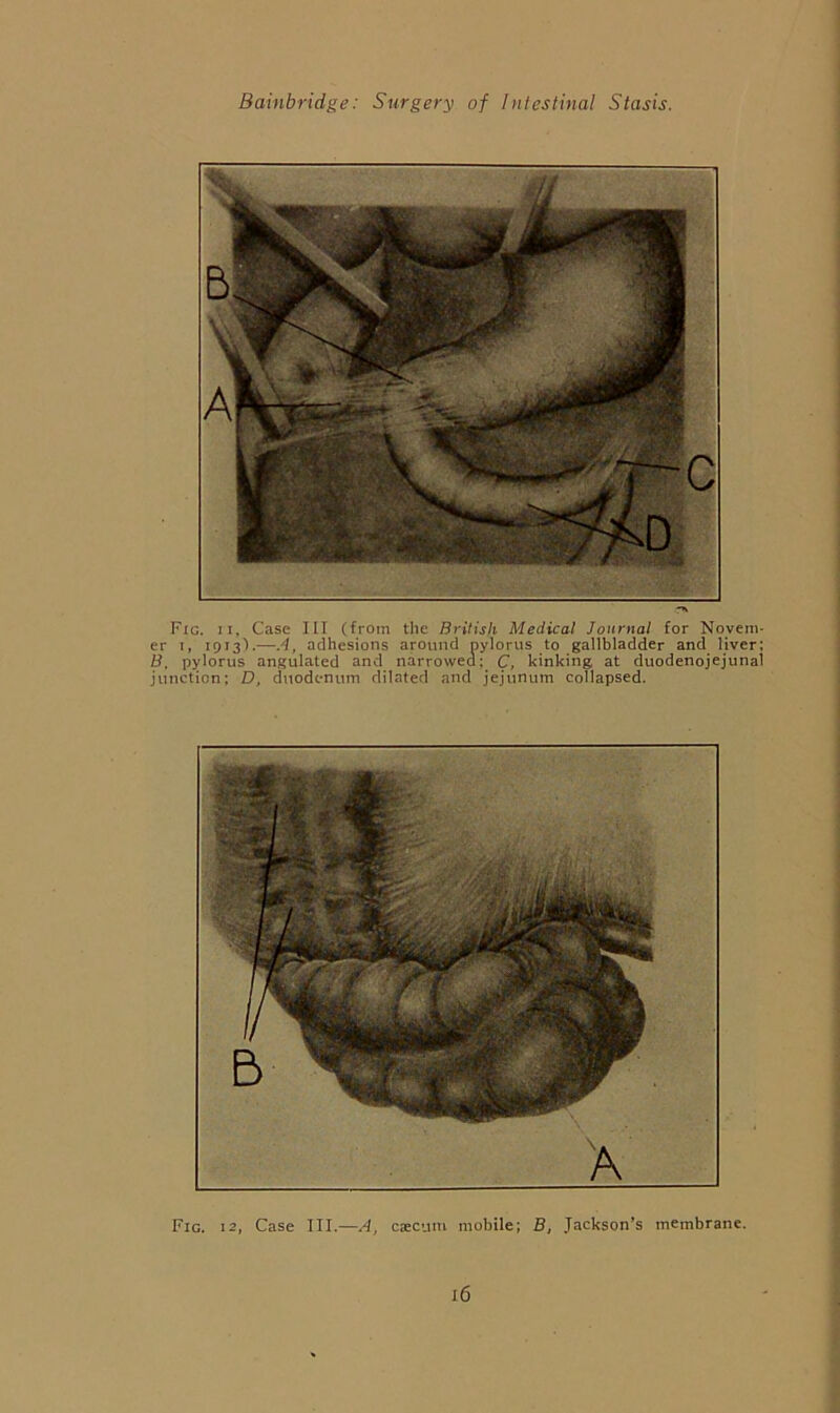 Fig. II, Case HI (from the British Medicat Journat for Novem- er I, 1913').—.d, adhesions around pylorus to gallbladder and liver; B. pylorus angulated and narrowed: C, kinking at duodenojejunal junction; D, duodenum dilated and jejunum collapsed. Fig. 12, Case III.—ciecum mobile; B, Jackson’s membrane.