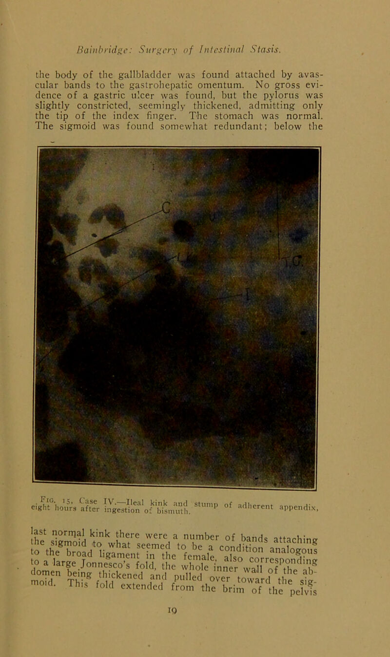 the body of the gallbladder was found attached by avas- cular bands to the gastrohepatJe omentum. No gross evi- dence of a gastric ulcer was found, but the pylorus was slightly constricted, seemingly thickened, admitting only the tip of the index finger. The stomach was normal. The sigmoid was found somewhat redundant; below the appendi.x. W a large JonnSrlold, S' wMe'innl“ ,»“1 of'’,re‘'ab^ IQ