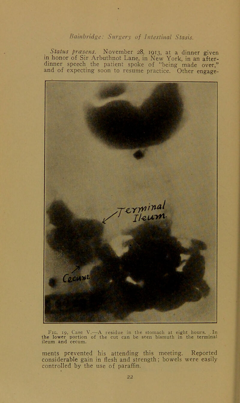 Status prwsens. November 28, 1913, at a dinner given in honor of Sir Arbuthnot Lane, in New York, in an after- dinner speech the patient spoke of “being made over,” and of expecting soon to resume practice. Other engage- Fig. 19, Case V.—A residue in the stoznach at eight hours. .In the lower portion of the cut can be seen bismuth in the terminal ileum and cecum. ments prevented his attending this meeting. Reported considerable gain in flesh and strength; bowels were easily controlled by the use of paraffin.