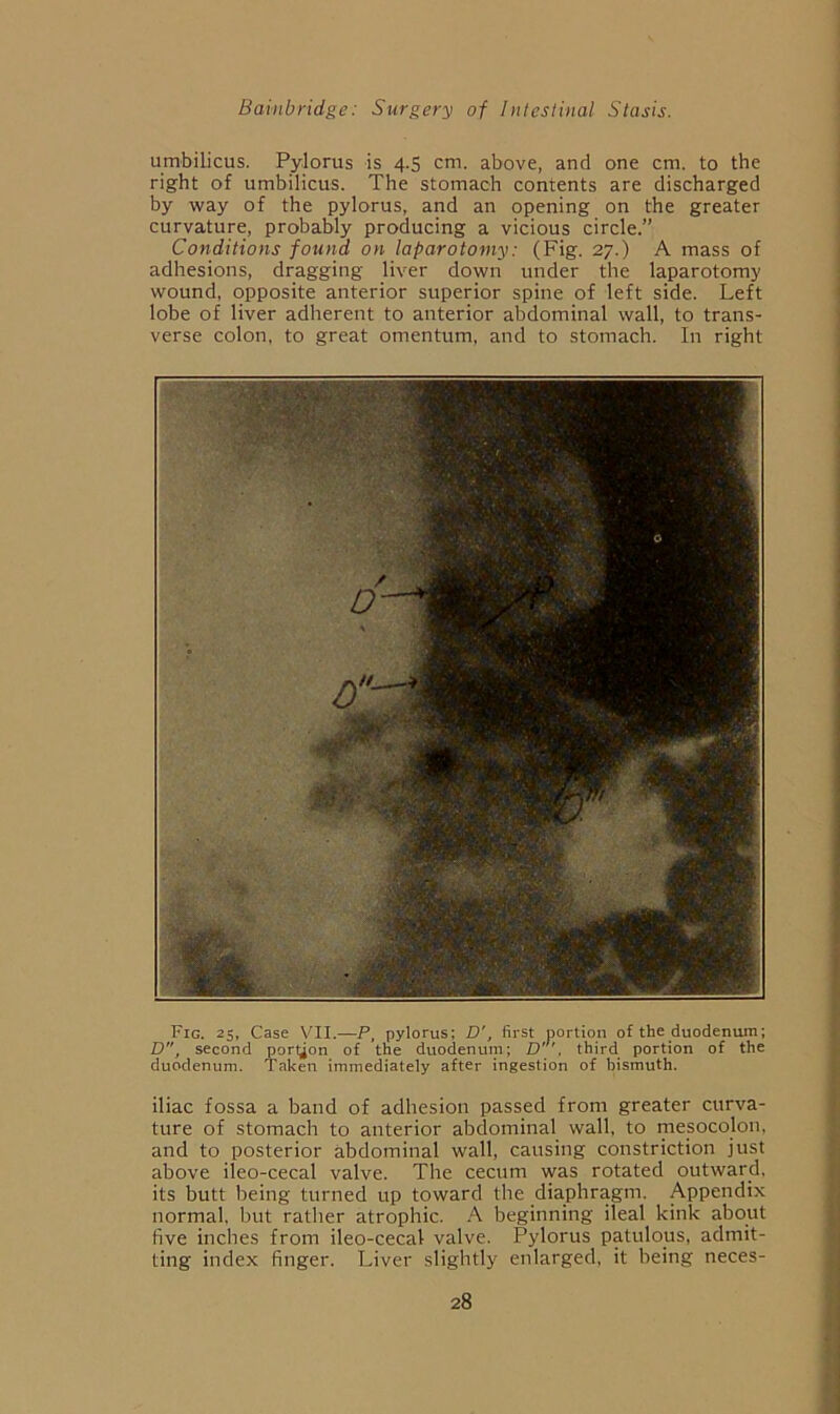 umbilicus. Pylorus is 4.5 cm. above, and one cm. to the right of umbilicus. The stomach contents are discharged by way of the pylorus, and an opening on the greater curvature, probably producing a vicious circle.” Conditions found on laparotomy: (Fig. 27.) A mass of adhesions, dragging liver down under the laparotomy wound, opposite anterior superior spine of left side. Left lobe of liver adherent to anterior abdominal wall, to trans- verse colon, to great omentum, and to stomach. In right Fig. 25, Case VII.—P, pylorus; D', first portion of the duodenum; D, second port,jon of the duodenum; third portion of the duodenum. Taken immediately after ingestion of bismuth. iliac fossa a band of adhesion passed from greater curva- ture of stomach to anterior abdominal wall, to mesocolon, and to posterior abdominal wall, causing constriction just above ileo-cecal valve. The cecum was rotated outward, its butt lieing turned up toward the diaphragm. Appendix normal, but rather atrophic. A beginning ileal kink about five inches from ileo-cecal valve. Pylorus patulous, admit- ting index finger. Liver slightly enlarged, it being neces-