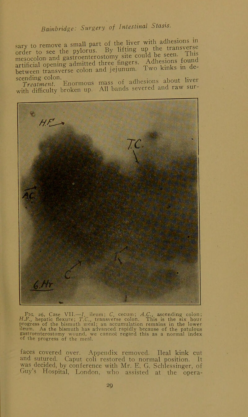 sarv to remove a small part of the liver with adhesions m oSr to Tee the pylorus. By lifting up the transverse mesocolon and gastroenterostomy site artificial opening admitted three fingers. Adhesions found between transverse colon and jejunum. Two kinks in ae scending colon. Treatment. Enormous with difficulty broken up. mass of adhesions about livei All bands severed and raw sur- Fig. 26, Case VII.—7, ileum; C, cecum; A.C., ascending colon; H.F., hepatic flexure; T.C., transverse colon. This is the six hour progress of the bismuth meal; an accumulation remains in the lower ileum. As the bismuth has advanced rapidly because of the patulous gastroenterostomy wound, we cannot regard this as a normal index of the progress of the meal. faces covered over, .^ppendix removed. Ileal kink cut and sutured. Caput coli restored to normal position. It was decided, by conference with Mr. E. G. Schlessinger, of Guy’s Hospital, London, who assisted at the opera-