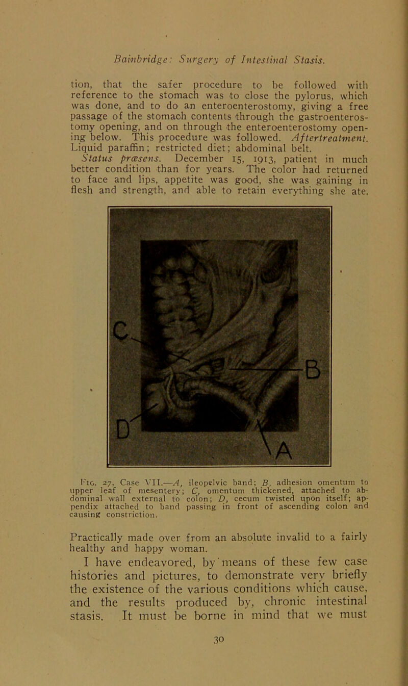 tion, that the safer procedure to be followed with reference to the stomach was to close the pylorus, which was done, and to do an enteroenterostomy, giving a free passage of the stomach contents through the gastroenteros- tomy opening, and on through the enteroenterostomy open- ing below. This procedure was followed. Aftertreatment. Liquid paraffin; restricted diet; abdominal belt. Status prcesens. December 15, 1913, patient in much better condition than for years. The color had returned to face and lips, appetite was good, she was gaining in flesh and strength, and able to retain everything she ate. I'lG. 27, Case VII.—A, ileopelvic band; B. adhesion omentum to upper leaf of mesentery; C, omentum thickened, attached to ab- dominal wall external to colon; D, cecum twisted upon itself; ap- pendix attached to band passing in front of ascending colon and causing constriction. Practically made over from an absolute invalid to a fairly healthy and happy woman. I have endeavored, by'means of these few case histories and pictures, to demonstrate very briefly the existence of the various conditions which cause, and the results produced by, chronic intestinal stasis. It must be borne in mind that we must