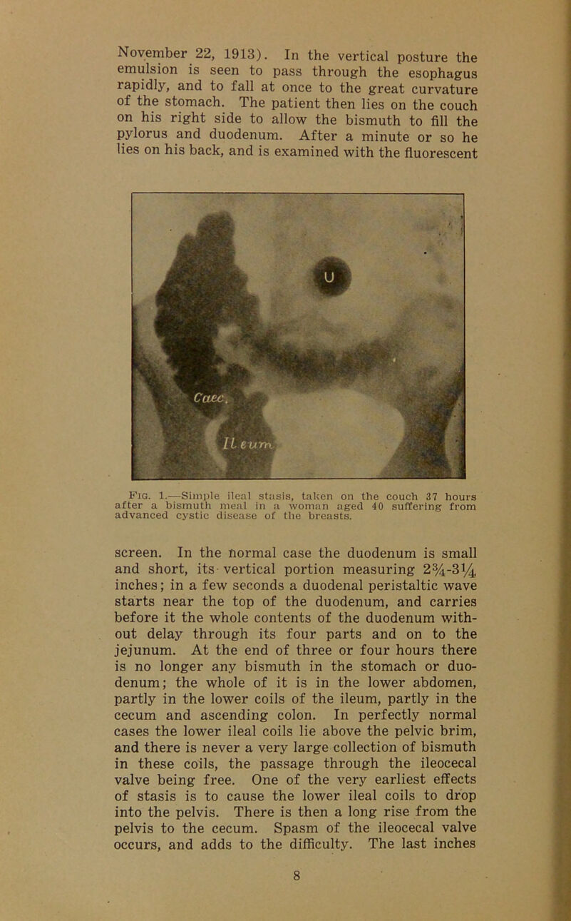 November 22, 1913). In the vertical posture the emulsion is seen to pass through the esophagus rapidly, and to fall at once to the great curvature of the stomach. The patient then lies on the couch on his right side to allow the bismuth to fill the pylorus and duodenum. After a minute or so he lies on his back, and is examined with the fluorescent Fig. 1.—Simple ileal stasis, taken on the couch 37 hours after a bismuth meal in a woman aged 40 suffering from advanced cystic disease of the breasts. screen. In the normal case the duodenum is small and short, its vertical portion measuring 23/4-31/4 inches; in a few seconds a duodenal peristaltic wave starts near the top of the duodenum, and carries before it the whole contents of the duodenum with- out delay through its four parts and on to the jejunum. At the end of three or four hours there is no longer any bismuth in the stomach or duo- denum; the whole of it is in the lower abdomen, partly in the lower coils of the ileum, partly in the cecum and ascending colon. In perfectly normal cases the lower ileal coils lie above the pelvic brim, and there is never a very large collection of bismuth in these coils, the passage through the ileocecal valve being free. One of the very earliest effects of stasis is to cause the lower ileal coils to drop into the pelvis. There is then a long rise from the pelvis to the cecum. Spasm of the ileocecal valve occurs, and adds to the difficulty. The last inches