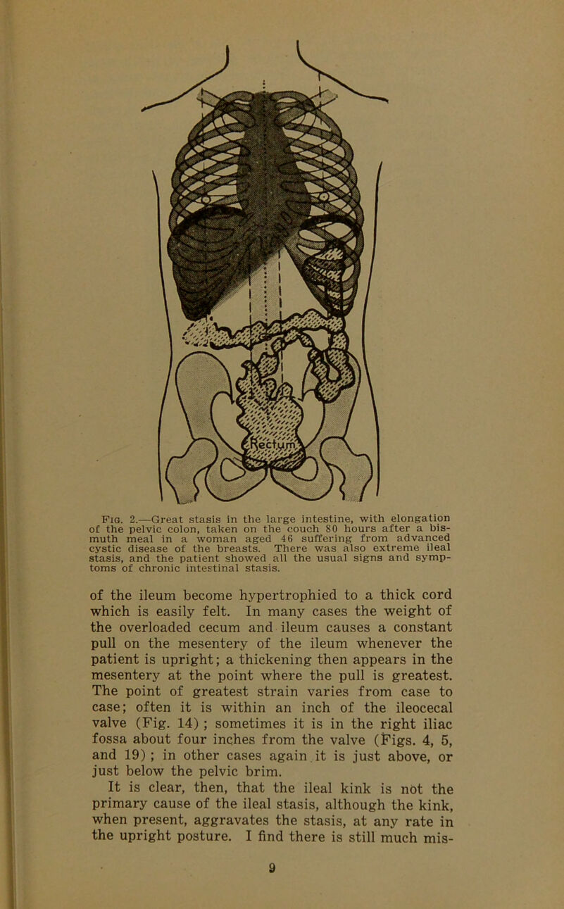 Fig. 2.—Great stasis in the large intestine, with elongation of the pelvic colon, taken on the couch 80 hours after a bis- muth meal in a woman aged 46 suffering from advanced cystic disease of the breasts. There was also extreme ileal stasis, and the patient showed all the usual signs and symp- toms of chronic intestinal stasis. of the ileum become hypertrophied to a thick cord which is easily felt. In many cases the weight of the overloaded cecum and ileum causes a constant pull on the mesentery of the ileum whenever the patient is upright; a thickening then appears in the mesentery at the point where the pull is greatest. The point of greatest strain varies from case to case; often it is within an inch of the ileocecal valve (Fig. 14) ; sometimes it is in the right iliac fossa about four inches from the valve (Figs. 4, 5, and 19) ; in other cases again it is just above, or just below the pelvic brim. It is clear, then, that the ileal kink is not the primary cause of the ileal stasis, although the kink, when present, aggravates the stasis, at any rate in the upright posture. I find there is still much mis-