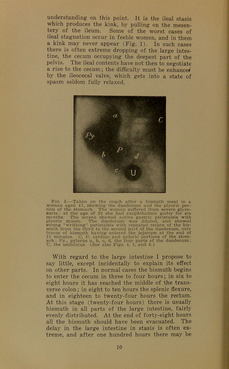 understanding on this point. It is the ileal stasis which produces the kink, by pulling on the mesen- tery of the ileum. Some of the worst cases of ileal stagnation occur in feeble women, and in them a kink may never appear (Fig. 1). In such cases there is often extreme dropping of the large intes- tine, the cecum occupying the deepest part of the pelvis. The ileal contents have not then to negotiate a rise to the cecum; the difficulty must be enhancer by the ileocecal valve, which gets into a state of spasm seldom fully relaxed. Fig. 3.—Taken on the couch after a bismuth meal in a woman aged 47, showing the duodenum and the plyoric por- tion of the stomach. The woman suffered from severe glyco- suria ; at the age of 30 she had exophthalmic goiter for six months. The screen showed active gastric peristalsis with plyoric spasm. The duodenum was dilated, and showed strong “writhing” peristalsis with repeated return of the bis- muth from the third to the second part of the duodenum, only traces of bismuth having entered the jejunum at the end of 15 minutes. C, P, cardiac and pyloric portions of the stom- ach ; Py., pylorus a, b, c, d, the four parts of the duodenum ; U, the umbilicus. (See also Figs. 4, 5, and 6.) With regard to the large intestine I propose to say little, except incidentally to explain its effect on other parts. In normal cases the bismuth begins to enter the cecum in three to four hours; in six to eight hours it has reached the middle of the trans- verse colon; in eight to ten hours the splenic flexure, and in eighteen to twenty-four hours the rectum. At this stage (twenty-four hours) there is usually bismuth in all parts of the large intestine, fairly evenly distributed. At the end of forty-eight hours all the bismuth should have been evacuated. The delay in the large intestine in stasis is often ex- treme, and after one hundred hours there may be