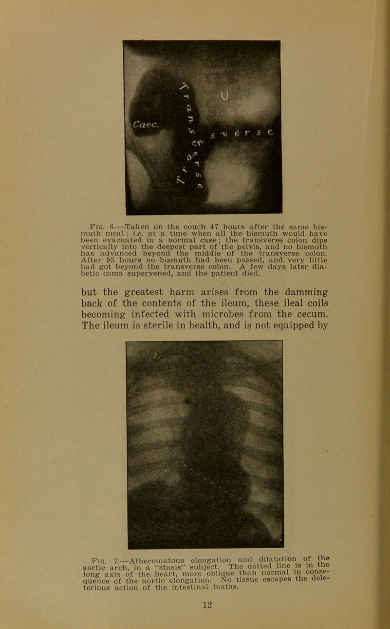 Fig. 6.—Taken on the couch 47 hours after the same bis- muth meal; i.e. at a time when all the bismuth would have been evacuated in a normal case ; the transverse colon dips vertically into the deepest part of the pelvis, and no bismuth has advanced beyond the middle of the transverse colon. After 95 hours no bismuth had been passed, and very little had got beyond the transverse colon. A few days later dia- betic coma supervened, and the patient died. but the greatest harm arises from the damming back of the contents of the ileum, these ileal coils becoming infected with microbes from the cecum. The ileum is sterile in health, and is not equipped by pIG. 7.—Atheromatous elongation and dilatation of the aortic arch, in a “stasis” subject. The dotted line is in the long axis of the heart, more oblique than normal in conse- quence of the aortic elongation. No tissue escapes the dele- terious action of the intestinal toxins.