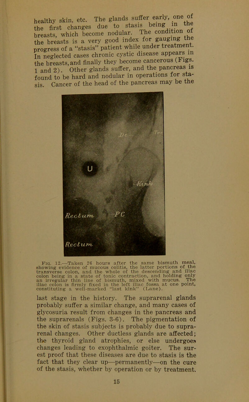 healthy skin, etc. The glands suffer early, one of the first changes due to stasis being in breasts, which become nodular. The condition of the breasts is a very good index for gauging progress of a “stasis” patient while under treatment. In neglected cases chronic cystic disease appears in the breasts,and finally they become cancerous (Figs. 1 and 2). Other glands suffer, and the pancreas is found to be hard and nodular in operations for sta- sis Cancer of the head of the pancreas may be the Fig. 12.—Taken 26 hours after the same bismuth meal, showing evidence of mucous colitis, the latter portions of the transverse colon, and the whole of the descending and iliac colon being in a state of tonic contraction, and holding only an irregular thin line of bismuth, mixed with mucus. The iliac colon is firmly fixed in the left iliac fossa at one point, constituting a well-marked “last kink” (Lane). last stage in the history. The suprarenal glands probably suffer a similar change, and many cases of glycosuria result from changes in the pancreas and the suprarenals (Figs. 3-6). The pigmentation of the skin of stasis subjects is probably due to supra- renal changes. Other ductless glands are affected; the thyroid gland atrophies, or else undergoes changes leading to exophthalmic goiter. The sur- est proof that these diseases are due to stasis is the fact that they clear up—permanently—on the cure of the stasis, whether by operation or by treatment.