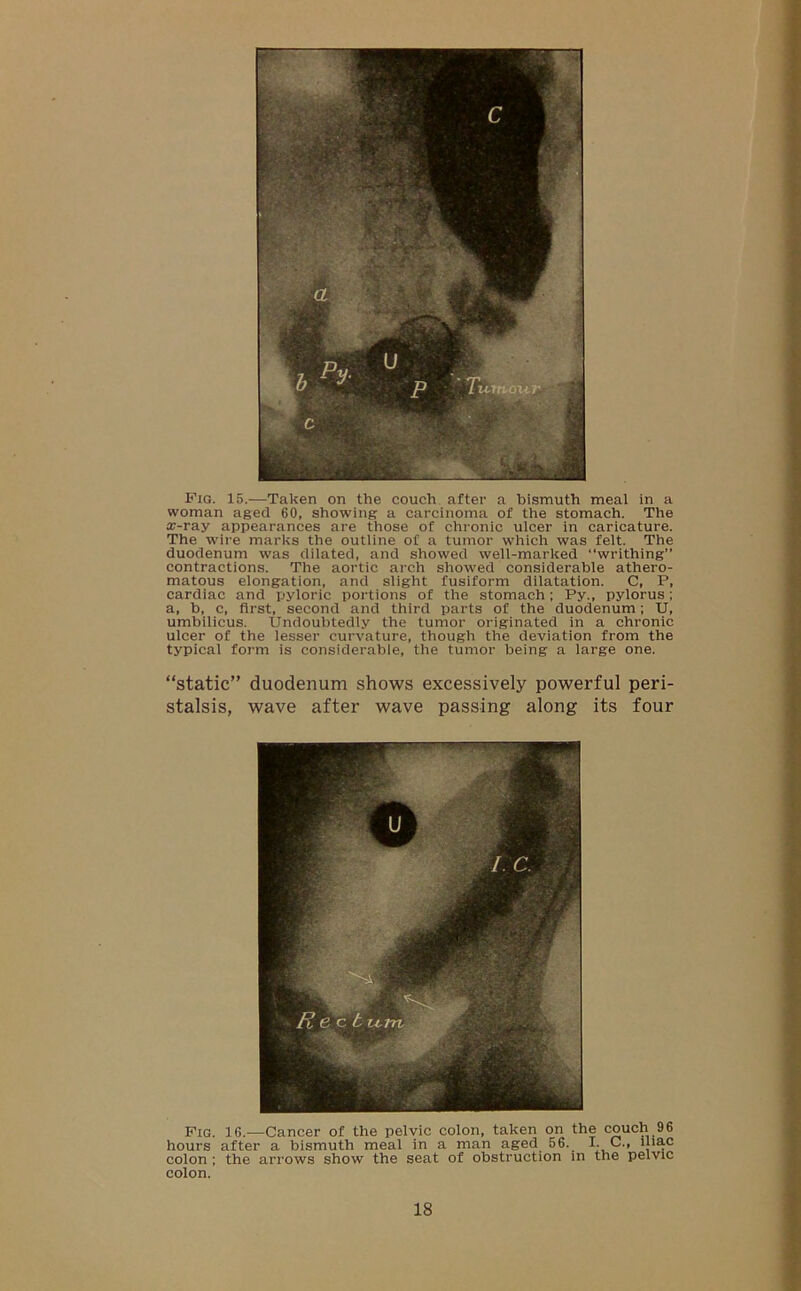 Fig. 15.—Taken on the couch after a bismuth meal in a woman aged 60, showing a carcinoma of the stomach. The ir-ray appearances are those of chronic ulcer in caricature. The wire marks the outline of a tumor which was felt. The duodenum was dilated, and showed well-marked writhing” contractions. The aortic arch showed considerable athero- matous elongation, and slight fusiform dilatation. C, P, cardiac and pyloric portions of the stomach; Py., pylorus; a, b, c, first, second and third parts of the duodenum; U, umbilicus. Undoubtedly the tumor originated in a chronic ulcer of the lesser curvature, though the deviation from the typical form is considerable, the tumor being a large one. “static” duodenum shows excessively powerful peri- stalsis, wave after wave passing along its four Fig. 16.-—Cancer of the pelvic colon, taken on the couch 96 hours after a bismuth meal in a man aged 56. I. C., iliac colon ; the arrows show the seat of obstruction in the pelvic coion.