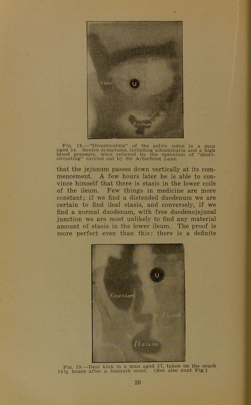 Fio. 18.—“Diverticulitis” of the pelvic colon in a man aged 54. Severe symptoms, including albuminuria and a high blood pressure, were relieved by the operation of “short- circuiting” carried out by Sir Arbuthnot Lane. that the jejunum passes down vertically at its com- mencement. A few hours later he is able to con- vince himself that there is stasis in the lower coils of the ileum. Few things in medicine are more constant; if we find a distended duodenum we are certain to find ileal stasis, and conversely, if we find a normal duodenum, with free duodenojejunal junction we are most unlikely to find any material amount of stasis in the lower ileum. The proof is more perfect even than this: there is a definite FIG. 19.—Ileal kink in a man aged 57, taken on the couch 10Va hours after a bismuth meal. (See also next Fig.)