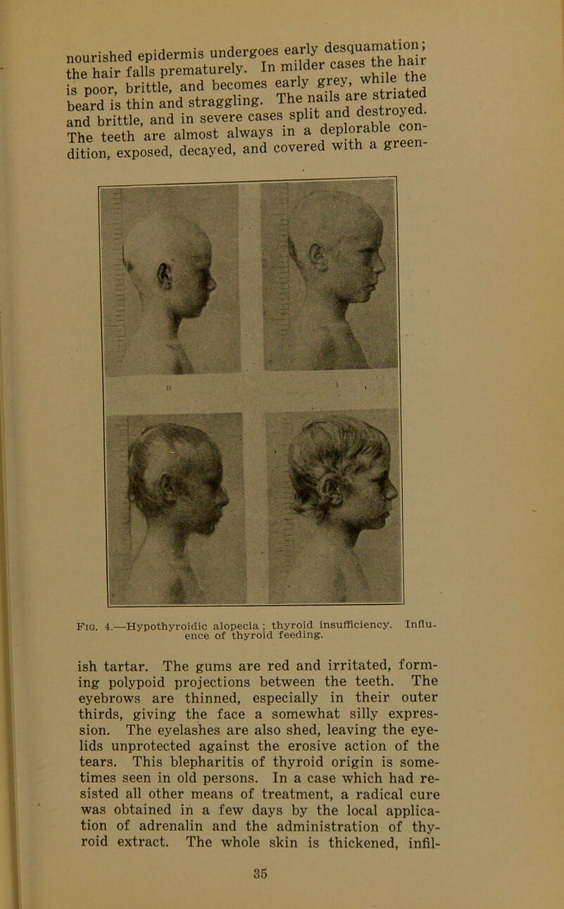 nourished epidermis undergoes the hair falls prematurely. In is poor, brittle, and becomes early grey whilethe beard is thin and straggling. The nai , destroyed and brittle, and in severe cases sPllta^de y • The teeth are almost always in a dcplorabie con dition, exposed, decayed, and covered with a green- Fig. 4.—Hypothyroidic alopecia ; thyroid insufficiency. Influ- ence of thyroid feeding. ish tartar. The gums are red and irritated, form- ing polypoid projections between the teeth. The eyebrows are thinned, especially in their outer thirds, giving the face a somewhat silly expres- sion. The eyelashes are also shed, leaving the eye- lids unprotected against the erosive action of the tears. This blepharitis of thyroid origin is some- times seen in old persons. In a case which had re- sisted all other means of treatment, a radical cure was obtained in a few days by the local applica- tion of adrenalin and the administration of thy- roid extract. The whole skin is thickened, infil-