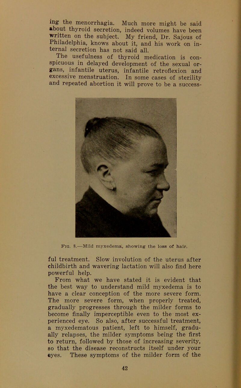 ing the menorrhagia. Much more might be said about thyroid secretion, indeed volumes have been written on the subject. My friend, Dr. Sajous of Philadelphia, knows about it, and his work on in- ternal secretion has not said all. The usefulness of thyroid medication is con- spicuous in delayed development of the sexual or- gans, infantile uterus, infantile retroflexion and excessive menstruation. In some cases of sterility and repeated abortion it will prove to be a success- Fig. 8.—Mild myxedema, showing the loss of hair. ful treatment. Slow involution of the uterus after childbirth and wavering lactation will also find here powerful help. From what we have stated it is evident that the best way to understand mild myxedema is to have a clear conception of the more severe form. The more severe form, when properly treated, gradually progresses through the milder forms to become finally imperceptible even to the most ex- perienced eye. So also, after successful treatment, a myxedematous patient, left to himself, gradu- ally relapses, the milder symptoms being the first to return, followed by those of increasing severity, so that the disease reconstructs itself under your eyes. These symptoms of the milder form of the