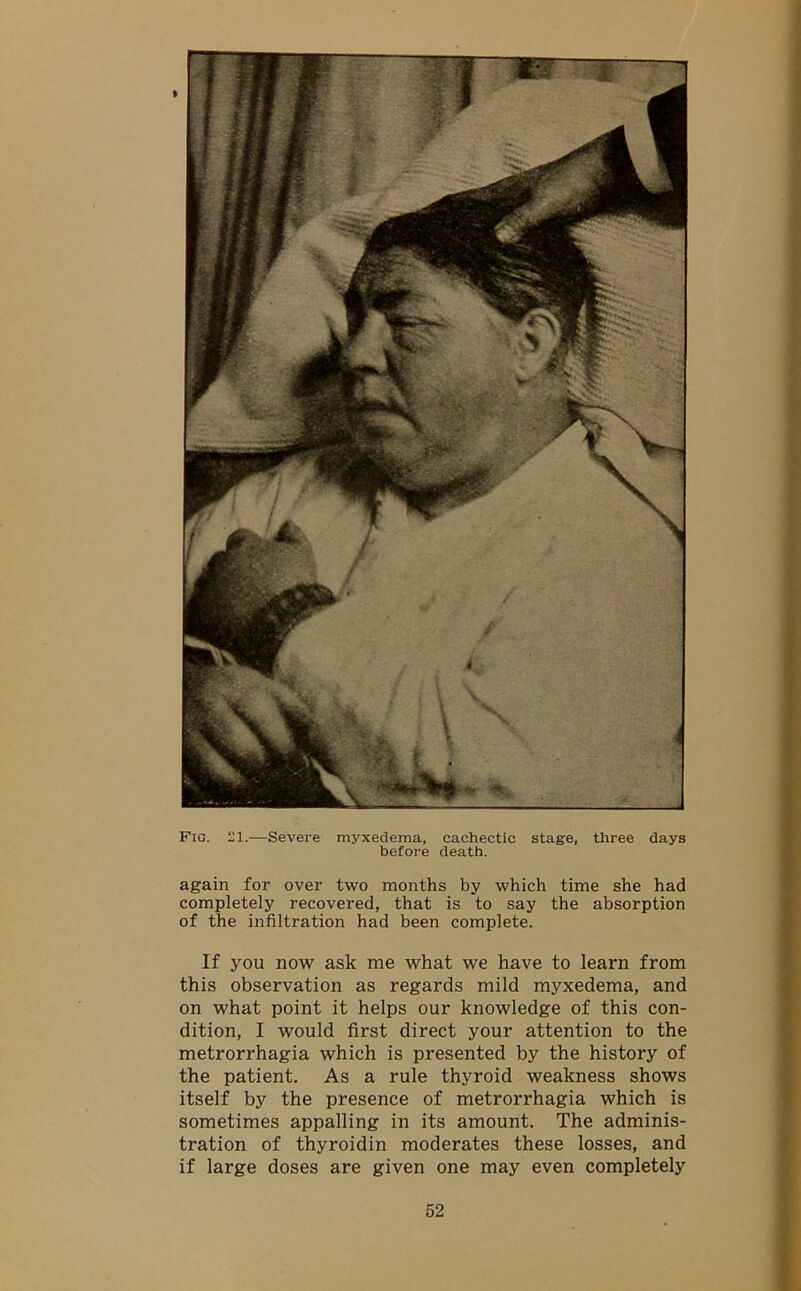 Fig. 21.—Severe myxedema, cachectic stage, three days before death. again for over two months by which time she had completely recovered, that is to say the absorption of the infiltration had been complete. If you now ask me what we have to learn from this observation as regards mild myxedema, and on what point it helps our knowledge of this con- dition, I would first direct your attention to the metrorrhagia which is presented by the history of the patient. As a rule thyroid weakness shows itself by the presence of metrorrhagia which is sometimes appalling in its amount. The adminis- tration of thyroidin moderates these losses, and if large doses are given one may even completely