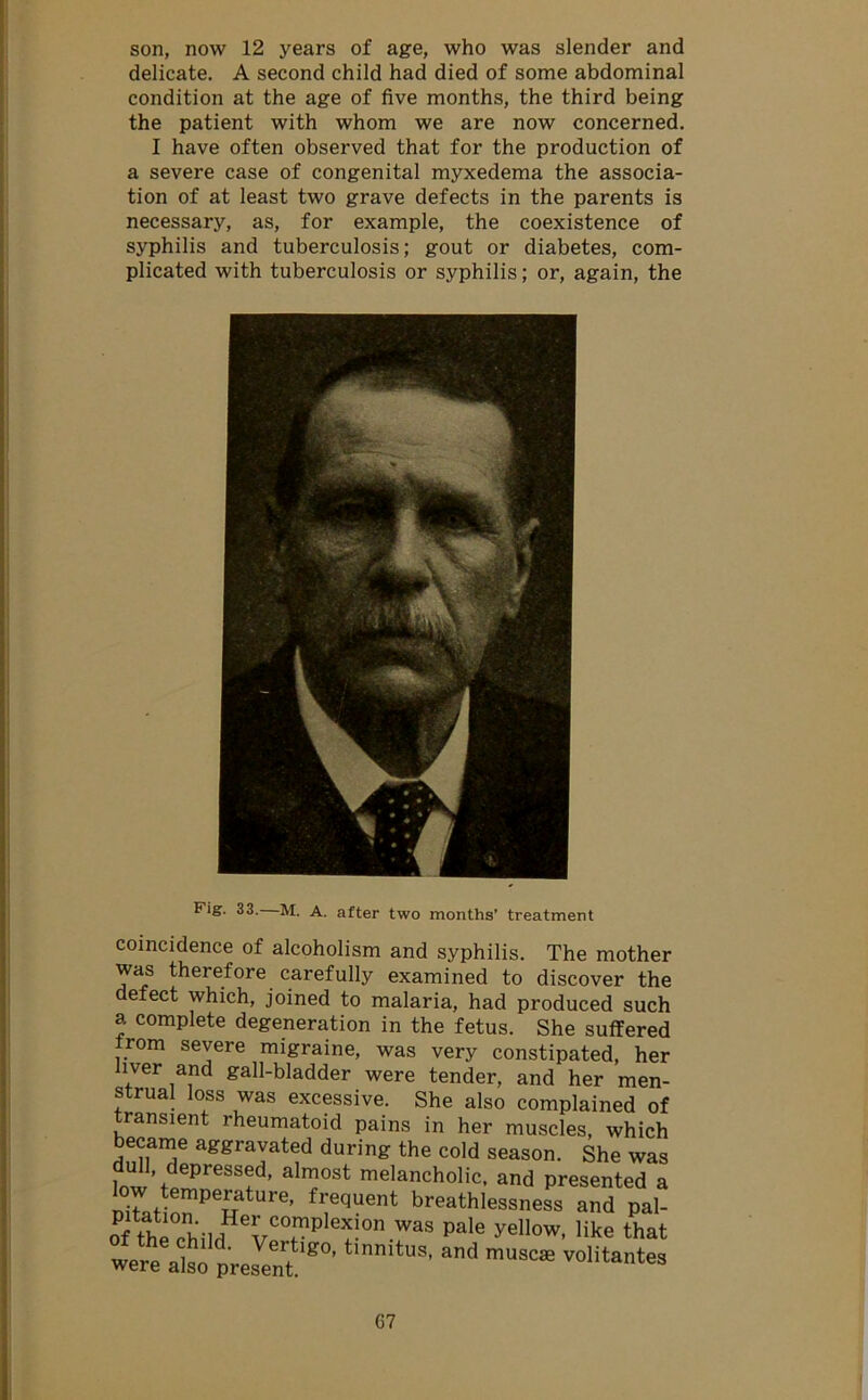 son, now 12 years of age, who was slender and delicate. A second child had died of some abdominal condition at the age of five months, the third being the patient with whom we are now concerned. I have often observed that for the production of a severe case of congenital myxedema the associa- tion of at least two grave defects in the parents is necessary, as, for example, the coexistence of syphilis and tuberculosis; gout or diabetes, com- plicated with tuberculosis or syphilis; or, again, the Fig. 33. M. A. after two months’ treatment coincidence of alcoholism and syphilis. The mother was therefore carefully examined to discover the efect which, joined to malaria, had produced such a complete degeneration in the fetus. She suffered trom severe migraine, was very constipated, her liver and gall-bladder were tender, and her men- strual loss was excessive. She also complained of transient rheumatoid pains in her muscles, which became aggravated during the cold season. She was dull depressed, almost melancholic, and presented a low temperature, frequent breathlessness and pal- nf tWh • e^CTpleX!on was Pale yellow, like that were also pre^nt g°’tmmtus’ and musc3e Mantes G7