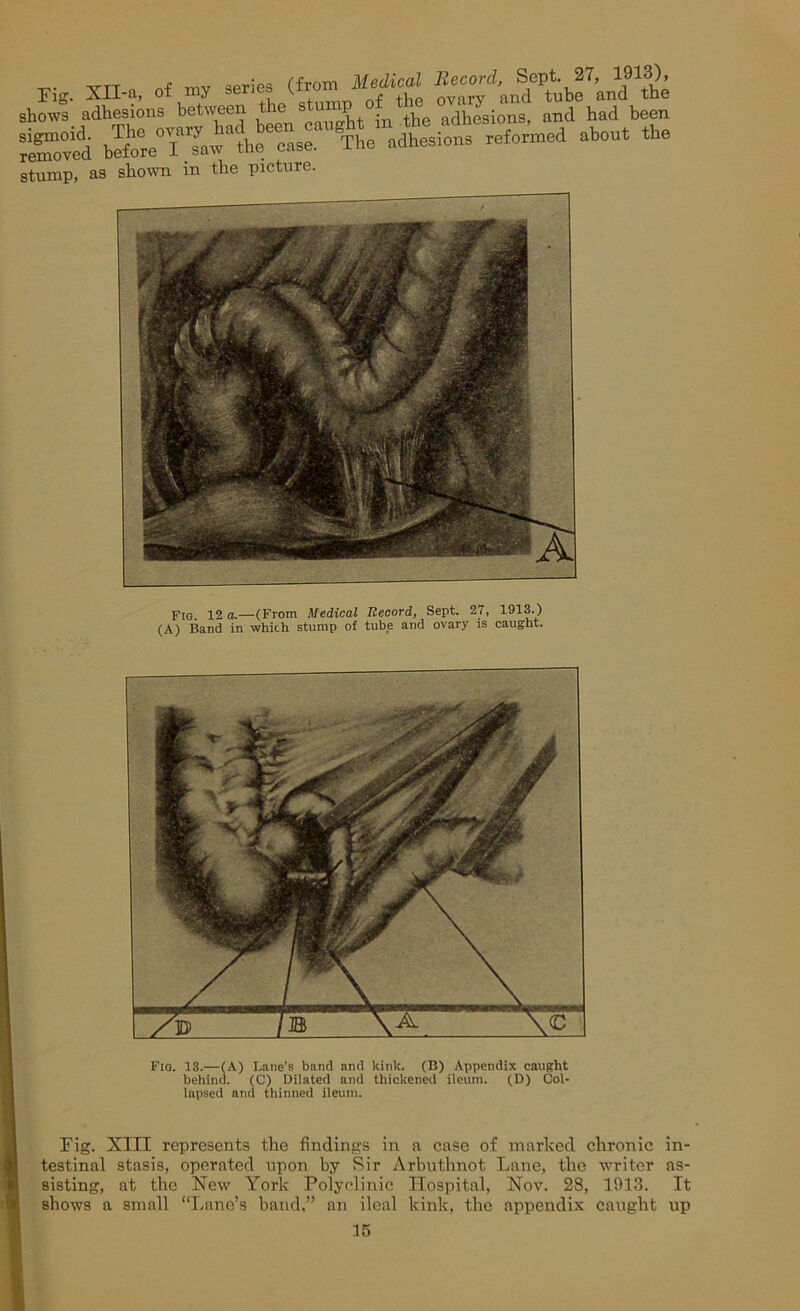 rig. XH-a, of my series (from Medtcd shows adhesions between the stump f t ad‘hesions, and had been SS5 brfore°YlTawaUieecase.aU^The1^dhesions reformed about the stump, as shown m the picture. Fig 12 a.—(From Medical Record, Sept. 27, 1913.) (A) Band in which stump of tube and ovary is caught. Fig. 13.—(A) Lane’s band and kink. (B) Appendix caught behind. (C) Dilated and thickened ileum. (D) Col- lapsed and thinned ileum. Eig. XIII represents the findings in a case of marked chronic in- testinal stasis, operated upon by Sir Arbuthnot Lane, the writer as- sisting, at the New York Polyclinic Hospital, Nov. 28, 1913. It shows a small “Lane’s band,” an ileal kink, the appendix caught up