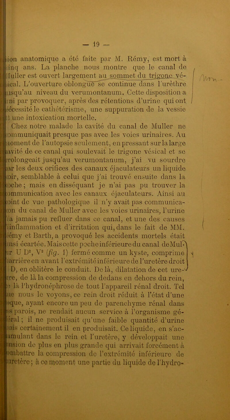 ion anatomiquo a été faite par M. Rémy, est mort à inq ans. La planche nous montre que le canal de luller est ouvert largement au sommet du trigone vé- lâcal. L'ouverture oblonguéAse continue dans l’urèthre usqu’au niveau du verumontanum. Cette disposition a ni par provoquer, après des rétentions d’urine qui ont écessitéle cathétérisme, une suppuration de la vessie une intoxication mortelle. Chez notre malade la cavité du canal de Muller ne orn mu niquait presque pas avec les voies urinaires. Au uoment de l’autopsie seulement, en pressant sur la large avité de ce canal qui soulevait le trigone vésical et se prolongeait jusqu’au verumontanum, j’ai vu sourdre aar les deux orifices des canaux éjaculateurs un liquide oir, semblable à celui que j’ai trouvé ensuite dans la Dche ; mais en disséquant je n’ai pas pu trouver la ommunioation avec les canaux éjaculateurs. Ainsi au Dint de vue pathologique il n’y avait pas communica- on du canal de Muller avec les voies urinaires, l’urine |Ya jamais pu refluer dans ce canal, et une des causes ; inflammation et d’irritation qui, dans le fait de MM. témy et Barth, a provoqué les accidents mortels était rnsi écartée. Mais cette poche inférieure du canal deMuP\ :r U I)2, V'2 (fig. 1) fermé comme un kyste, comprime ^arrière en avant l’extrémité inférieure de l’uretère droit D, en oblitère le conduit. Delà, dilatation de cet ure-^ ire, de là la compression de dedans en dehors du rein, ;m là Phydronéphrose de tout l’appareil rénal droit. Tel ic nous le voyons, ce rein droit réduit à l’état d’une que, ayant encore un peu de parenchyme rénal dans s parois, ne rendait aucun service à l’organisme gé- *ral ; il ne produisait qu’une faible quantité d’urine ais certainement il en produisait. Ce liquide, en s’ac- imulant dans le rein et P uretère, y développait une nsion de plus en plus grande qui arrivait forcément à •mbattre la compression de l’extrémité inférieure de uretère; à ce moment une partie du liquide del’hydro- i > 1 V/rv\.