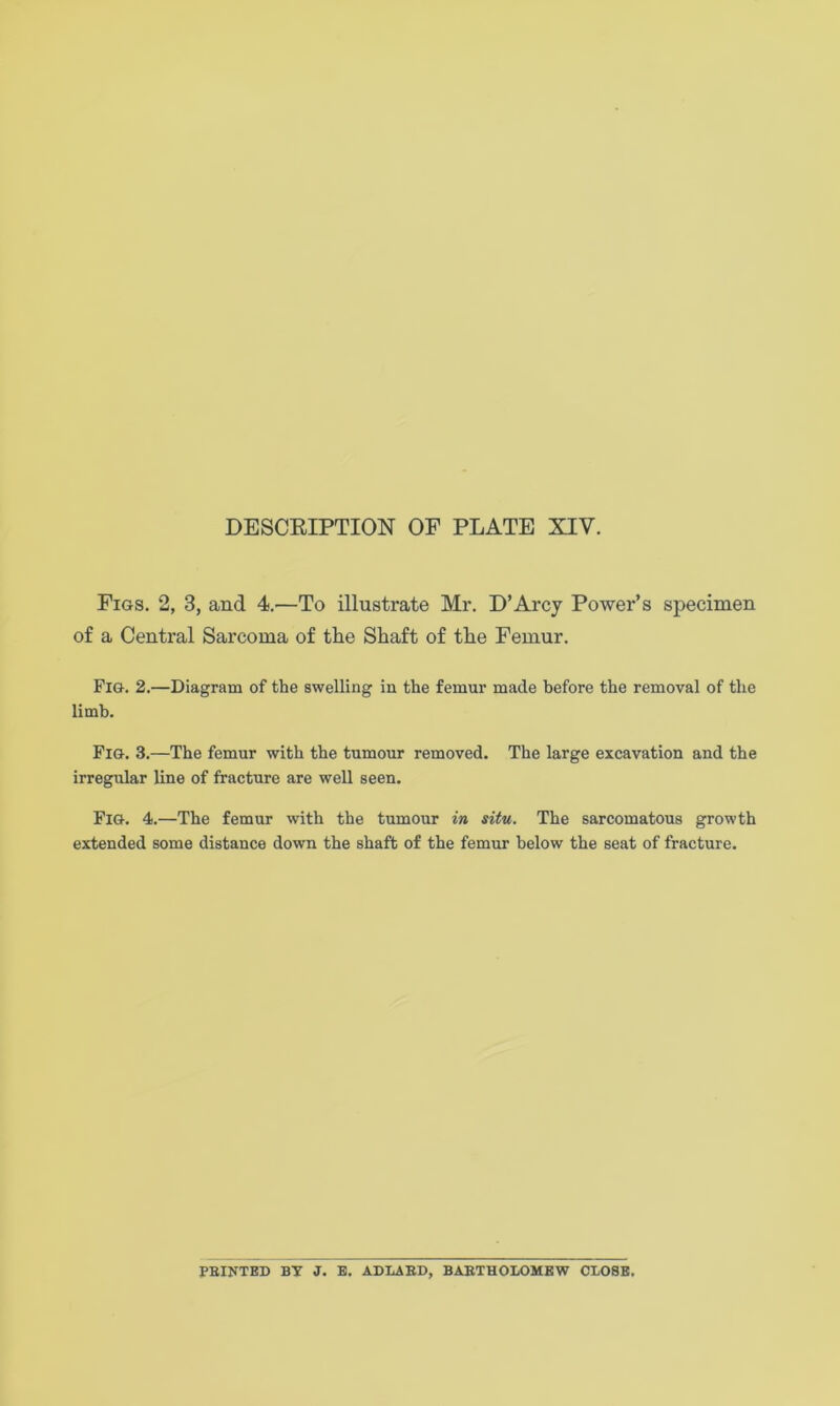 DESCRIPTION OF PLATE XIV. Figs. 2, 3, and 4.—To illustrate Mr. D’Arcy Power’s specimen of a Central Sarcoma of the Shaft of the Femur. Fig. 2.—Diagram of the swelling in the femur made before the removal of the limb. Fig. 3.—The femur with the tumour removed. The large excavation and the irregular line of fracture are well seen. Fig. 4.—The femur with the tumour in situ. The sarcomatous growth extended some distance down the shaft of the femur below the seat of fracture. PRINTED BY J. E. ADLARD, BARTHOLOMEW CLOSE.