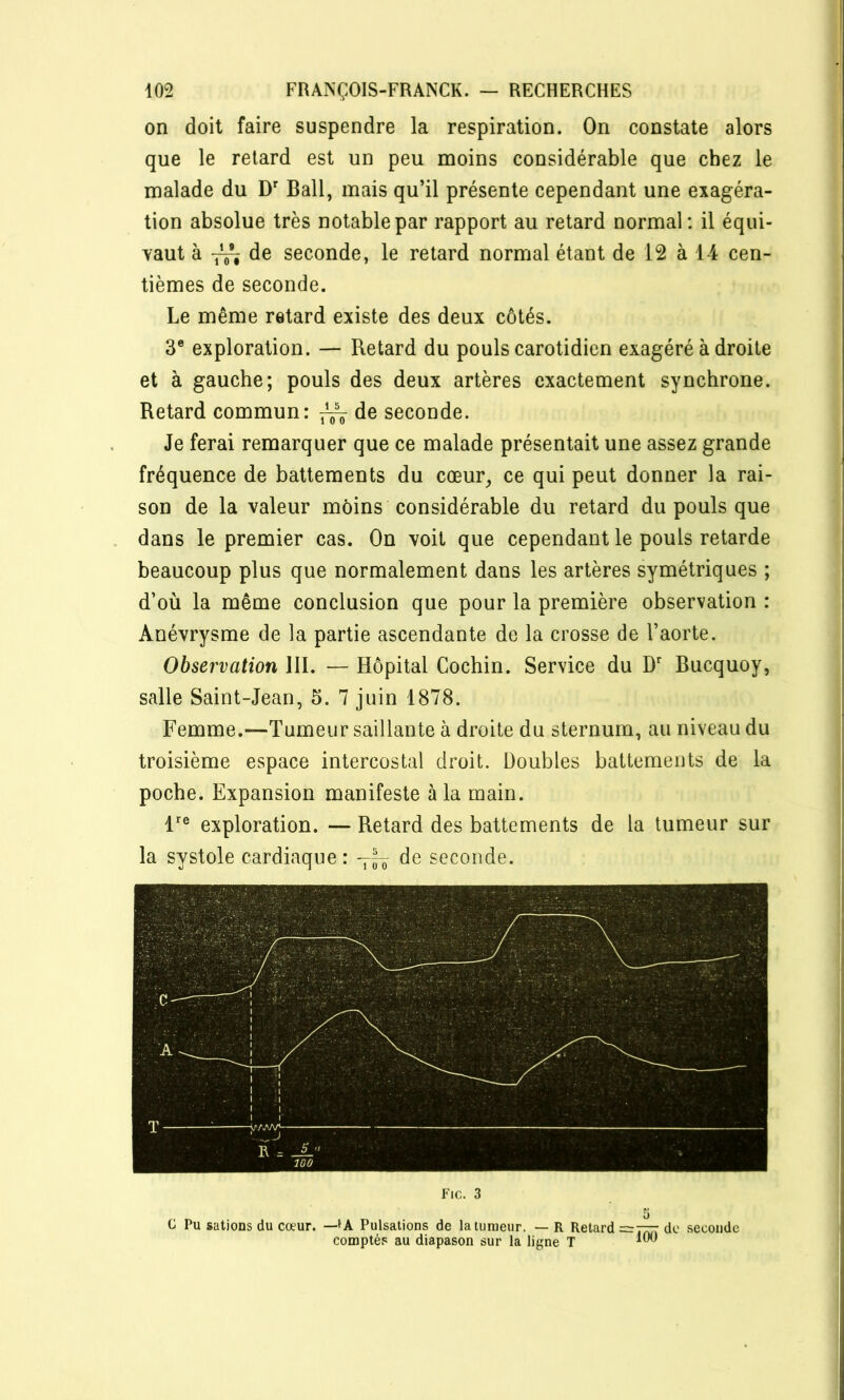 on doit faire suspendre la respiration. On constate alors que le retard est un peu moins considérable que chez le malade du D Bail, mais qu’il présente cependant une exagéra- tion absolue très notable par rapport au retard normal: il équi- vaut à de seconde, le retard normal étant de 12 à 14 cen- tièmes de seconde. Le même retard existe des deux côtés. 3® exploration. — Retard du pouls carotidien exagéré à droite et à gauche; pouls des deux artères exactement synchrone. Retard commun: ^ de seconde. Je ferai remarquer que ce malade présentait une assez grande fréquence de battements du cœur^ ce qui peut donner la rai- son de la valeur moins considérable du retard du pouls que dans le premier cas. On voit que cependant le pouls retarde beaucoup plus que normalement dans les artères symétriques ; d’où la même conclusion que pour la première observation : Anévrysme de la partie ascendante de la crosse de l’aorte. Observation 111. — Hôpital Cochin. Service du D Bucquoy, salle Saint-Jean, 5. 7 juin 1878. Femme.—Tumeur saillante à droite du sternum, au niveau du troisième espace intercostal droit. Doubles battements de la poche. Expansion manifeste à la main. 1'^® exploration. — Retard des battements de la tumeur sur la systole cardiaque : de seconde. Fie. 3 5 C Pu salions du cœur. —Pulsations de la tumeur. — R Retard ==77^ de seconde comptés au diapason sur la ligne T