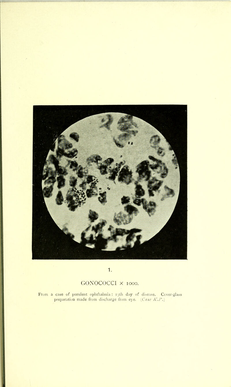 1. GONOCOCCI X looo. From a case of purulent ophthalmia : 13th day of disease. Cover-glass preparation made from discharge from eje. {Case K.F.]