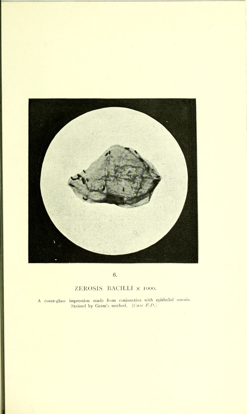 I 6. ZJ^ROSIS J>AClLLt X looo. A cover-glass impression made from coniimctiva with epithelial zemsis. Stained by Gram’s method, {Case F.P.)