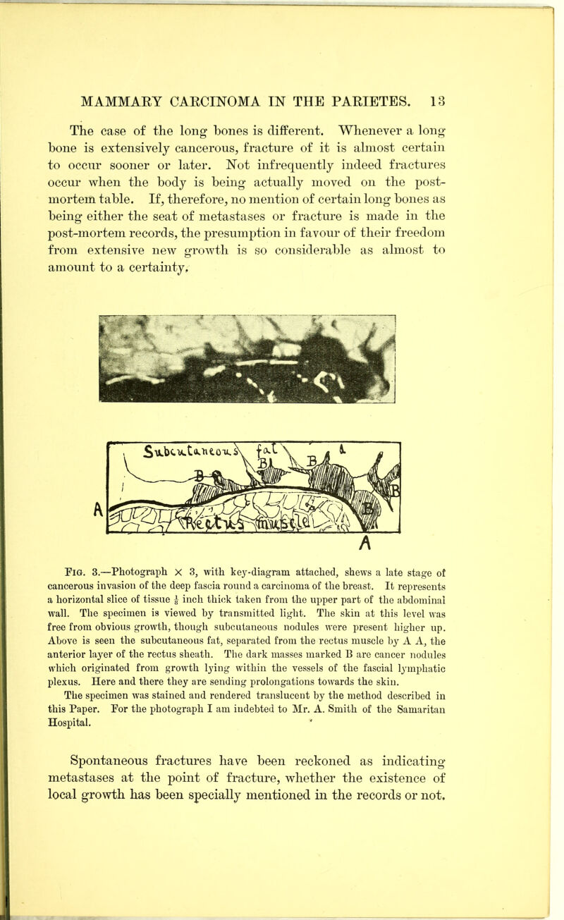 The case of the long bones is different. Whenever a long bone is extensively cancerous, fracture of it is almost certain to occur sooner or later. Not infrequently indeed fractures occur when the body is being actually moved on the post- mortem table. If, therefore, no mention of certain long bones as being either the seat of metastases or fracture is made in the post-mortem records, the presumption in favour of their freedom from extensive new errowth is so considerable as almost to amount to a certainty, Pig. 3.—Photograph X 3, with key-diagram attached, shews a late stage of cancerous invasion of the deep fascia round a carcinoma of the breast. It represents a horizontal slice of tissue ^ inch thick taken from the upper part of the abdominal wall. The specimen is viewed by transmitted light. The skin at this level was free from obvious growth, though subcutaneous nodules were present higher up. Above is seen the subcutaneous fat, separated from the rectus muscle by A A, the anterior layer of the rectus sheath. The dark masses marked B are cancer nodules which originated from growth lying within the vessels of the fascial lymphatic plexus. Here and there they are sending prolongations towards the skin. The specimen was stained and rendered translucent by the method described in this Paper. Por the photograph I am indebted to Mr. A. Smith of the Samaritan Hospital. Spontaneous fractures have been reckoned as indicating metastases at the point of fracture, whether the existence of local growth has been specially mentioned in the records or not.