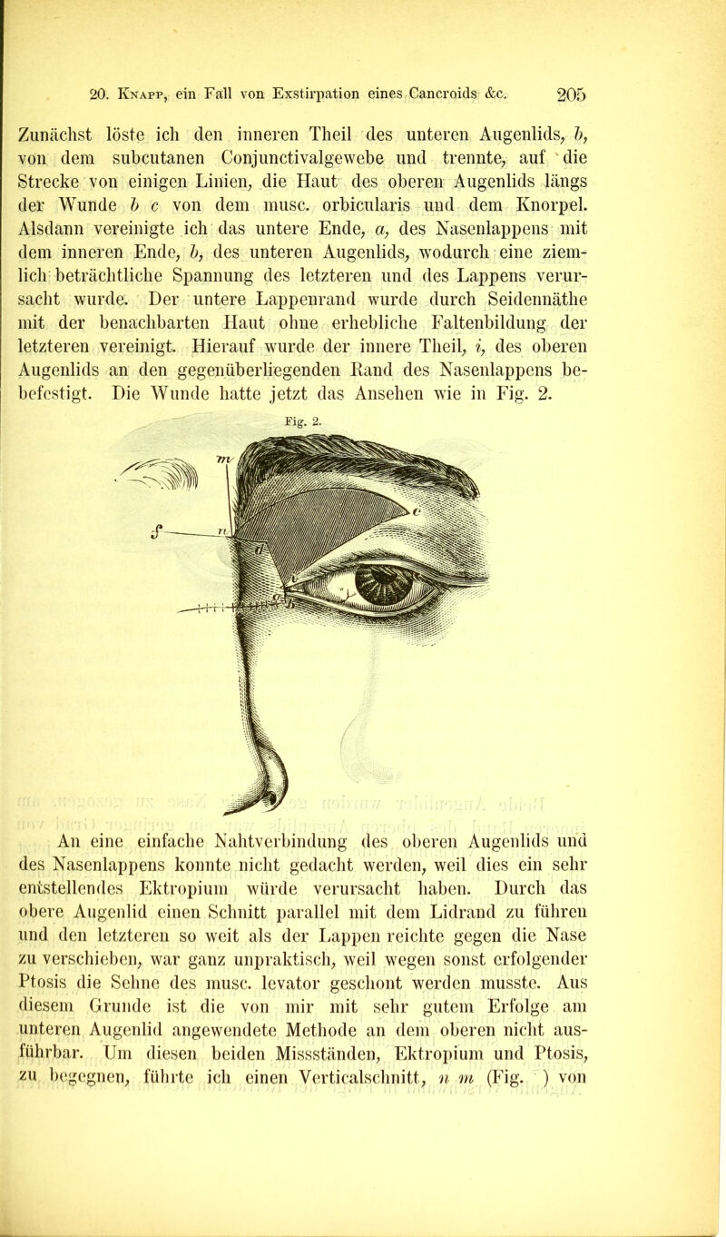 Zunächst löste ich den inneren Theil des unteren Augenlids^ ö, von dem subcutanen Conjunctivalgewebe und trennte^ auf die Strecke von einigen Linien^ die Haut des oberen Augenlids längs der Wunde h c von dem musc. orbicnlaris und dem Knorpel. Alsdann vereinigte ich das untere Ende, a, des Nasenlappens mit dem inneren Ende, 5, des unteren Augenlids, wodurch eine ziem- lich beträchtliche Spannung des letzteren und des Lappens verur- sacht wurde. Der untere Lappenrand wurde durch Seidennäthe mit der benachbarten Haut ohne erhebliche Faltenbildung der letzteren vereinigt. Hierauf wurde der innere Theil, % des oberen Augenlids an den gegenüberliegenden Kand des Nasenlappens be- befcstigt. Die Wunde hatte jetzt das Ansehen wie in Fig. 2. Fig. 2. Au eine einfache Nahtverbindung des oberen Augenlids und des Nasenlappens konnte nicht gedacht werden, weil dies ein sehr entstellendes Ektropium würde verursacht haben. Durch das obere Augenlid einen Schnitt parallel mit dem Lidrand zu führen und den letzteren so weit als der Lappen reichte gegen die Nase zu verschieben, war ganz unpraktisch, weil wegen sonst erfolgender Ptosis die Sehne des musc. levator geschont werden musste. Aus diesem Grunde ist die von mir mit sehr gutem Erfolge am unteren Augenlid angewendete Methode an dem oberen nicht aus- führbar. Um diesen beiden Missständen, Ektropium und Ptosis, zu begegnen, fülirte ich einen Verticalschnitt, n m (Fig. ) von