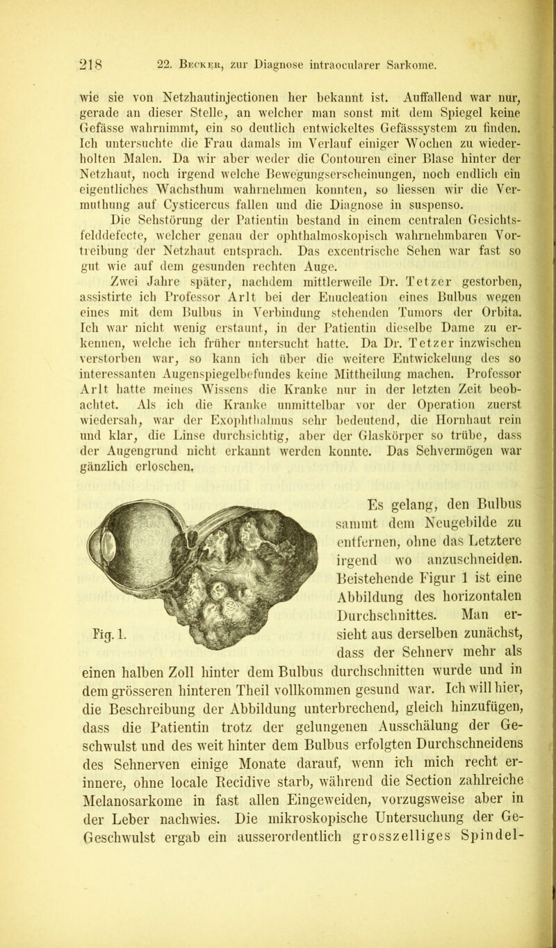 wie sie von Netzhaiitinjectionen her bekannt ist. Auffallend war nur, gerade an dieser Stelle, an welcher man sonst mit dem Spiegel keine Gefässe wahrnimmt, ein so deutlich entwickeltes Gefässsystem zu finden. Ich untersuchte die Frau damals im Verlauf einiger Wochen zu wieder- holten Malen. Da wir aber weder die Contouren einer Blase hinter der Netzhaut, noch irgend welche Bewegungserscheinungen, noch endlich ein eigentliches Wachsthum wahrnehmen konnten, so Hessen wir die Ver- mut hung auf Cysticercus fallen und die Diagnose in suspenso. Die Sehstörung der Patientin bestand in einem centralen Gesichts- felddefecte, welcher genau der ophthalmoskopisch wahrnehmbaren Vor- treibung der Netzhaut entsprach. Das excentrische Sehen war fast so gut wie auf dem gesunden rechten Auge. Zwei Jahre später, nachdem mittlerweile Dr. Tetzer gestorben, assistirte ich Professor Arlt bei der Enucleation eines Bulbus wegen eines mit dem Bulbus in Verbindung stehenden Tumors der Orbita. Ich war nicht wenig erstaunt, in der Patientin dieselbe Dame zu er- kennen, welche ich früher untersucht hatte. Da Dr. Tetzer inzwischen verstorben war, so kann ich über die weitere Entwickelung des so interessanten Augenspiegelbefundes keine Mittheilung machen. Professor Arlt hatte meines Wissens die Kranke nur in der letzten Zeit beob- achtet. Als ich die Kranke unmittelbar vor der Operation zuerst wiedersah, war der Exoi)litlialmus sehr bedeutend, die Hornhaut rein und klar, die Linse durclisichtig, aber der Glaskörper so trübe, dass der Augengrund nicht erkannt werden konnte. Das Sehvermögen war gänzlich erloschen, Es gelang, den Bulbus sanimt dem Neugebilde zu entfernen, ohne das Letztere irgend wo anzuschneiden. Beistehende Figur 1 ist eine Abbildung des horizontalen Durchschnittes. Man er- sieht aus derselben zunächst, dass der Sehnerv mehr als einen halben Zoll hinter dem Bulbus durchschnitten wurde und in dem grösseren hinteren Theil vollkommen gesund war. Ich will hier, die Beschreibung der Abbildung unterbrechend, gleich hinzufügen, dass die Patientin trotz der gelungenen Ausschälung der Ge- schwulst und des weit hinter dem Bulbus erfolgten Durchschneidens des Sehnerven einige Monate darauf, wenn ich mich recht er- innere, ohne locale Recidive starb, während die Section zahlreiche Melanosarkome in fast allen Eingew^eiden, vorzugsweise aber in der Leber nachwies. Die mikroskopische Untersuchung der Ge- Geschwulst ergab ein ausserordentlich grosszeiliges Spindel-