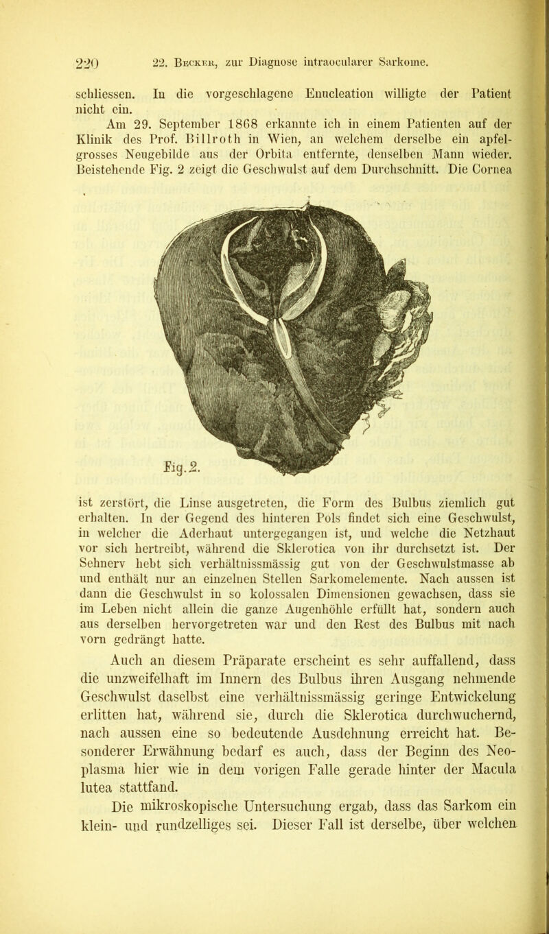 scliliessen. In die vorgeschlagene Eimcleation willigte der Patient nicht ein. Am 29. September 1868 erkannte ich in einem Patienten auf der Klinik des Prof. Billroth in Wien, an welchem derselbe ein apfel- grosses Neiigebilde aus der Orbita entfernte, denselben Mann wieder. Beistehende Fig. 2 zeigt die Geschwulst auf dem Durchschnitt. Die Cornea ist zerstört, die Linse ausgetreten, die Form des Bulbus ziemlich gut erhalten. In der Gegend des hinteren Pols findet sich eine Geschwulst, in welcher die Aderhaut untergegangen ist, und welche die Netzhaut vor sich hertreibt, während die Sklerotica von ihr durchsetzt ist. Der Sehnerv hebt sich verhältnissmässig gut von der Geschwulstmasse ab und enthält nur an einzelnen Stellen Sarkomelemente. Nach aussen ist dann die Geschwulst in so kolossalen Dimensiouen gewachsen, dass sie im Leben nicht allein die ganze Augenhöhle erfüllt hat, sondern auch aus derselben hervorgetreten war und den Rest des Bulbus mit nach vorn gedrängt hatte. Auch an diesem Präparate erscheint es sehr auffallend, dass die unzweifelhaft im Innern des Bulbus ihren Ausgang nehmende Geschwulst daselbst eine verhältnissmässig geringe Entwickelung erlitten hat, während sie, durch die Sklerotica durchwuchernd, nach aussen eine so bedeutende Ausdehnung erreicht hat. Be- sonderer Erwähnung bedarf es auch, dass der Beginn des Neo- plasma hier wie in dem vorigen Falle gerade hinter der Macula lutea stattfand. Die mikroskopische Untersuchung ergab, dass das Sarkom ein klein- und rundzelliges sei. Dieser Fall ist derselbe, über welchen