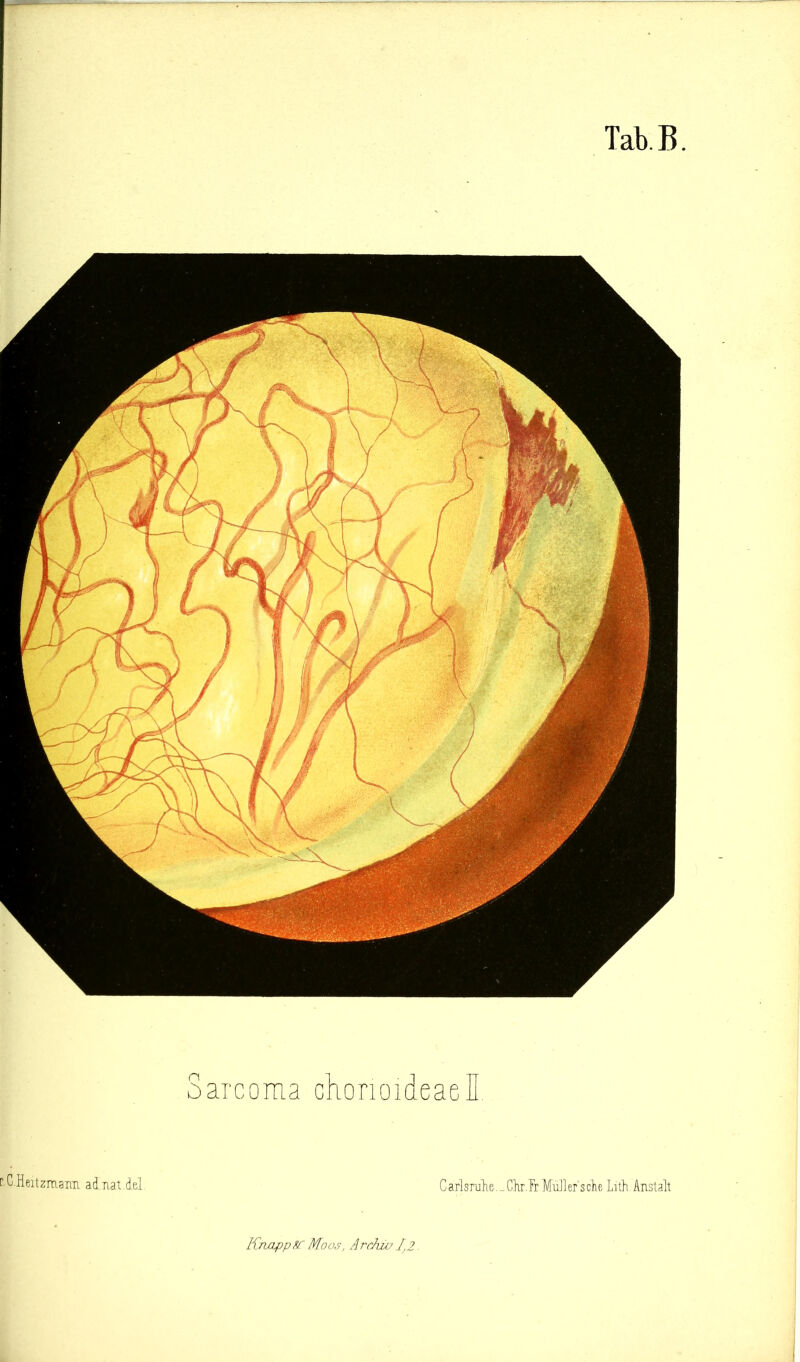 C.Heitzmarai adnat del Carlsrube. _ ClirTr MuJler’sdie Lith Anstalt Sarcoma chonoideaell Kndpp^ Moos, Arckuj 1,2