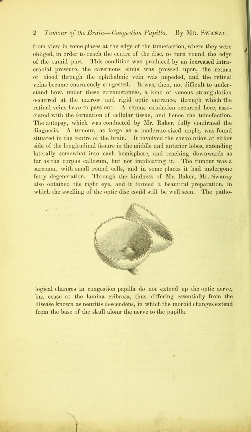 2 Tumour of the Brain—Congestion Fapilla. By Mr. Swanzy. from view in some places at tiie edge of the tumefaction, where they were obliged, in order to reach the centre of the disc, to turn round the edge of the tumid part. This condition was produced by an increased intra- cranial pressure, the cavernous sinus was pressed upon, the return of blood through the ophthalmic vein was impeded, and the retinal veins became enormously congested. It was, then, not difficult to under- stand how, under these circumstances, a kind of venous strangulation occurred at the narrow and rigid optic entrance, through which the retinal veins have to pass out. A serous exudation occurred here, asso- ciated with the formation of cellular tissue, and hence the tumefaction. The autopsy, which was conducted by Mr. Baker, fully confirmed the diagnosis. A tumour, as large as a moderate-sized apple, was found situated in the centre of the brain. It involved the convolution at either side of the longitudinal fissure in the middle and anterior lobes, extending laterally somewhat into each hemisphere, and reaching downwards as far as the corpus callosum, but not implicating it. The tumour was a sarcoma, with small round cells, and in some places it had undergone fatty degeneration. Through the kindness of Mr. Baker, Mr. Swanzy also obtained the right eye, and it formed a beautiful preparation, in which the swelling of the optic disc could still be well seen. The patho- logical changes in congestion papilla do not extend up the optic nerve, but cease at the lamina cribrosa, thus differing essentially from the disease known as neuritis descendens, in which the morbid changes extend from the base of the skull along the nerve to the papilla.