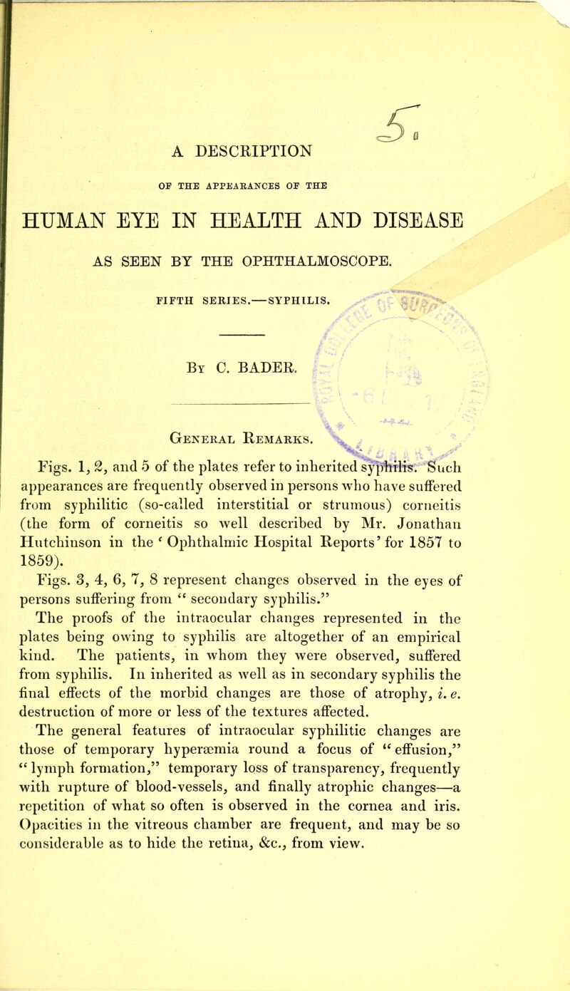 A DESCRIPTION OP THE APPEAEANCES OP THE HUMAN EYE IN HEALTH AND DISEASE AS SEEN BY THE OPHTHALMOSCOPE. FIFTH SERIES.— SYPHILIS. By C. BADER. General Remarks. Figs. 1, and 5 of the plates refer to inherited sypliilrs. Such appearances are frequently observed in persons who have sulFered from syphilitic (so-called interstitial or strumous) coriieitis (the form of corneitis so well described by Mr. Jonathan Hutchinson in the ^Ophthalmic Hospital Reports’for 1857 to 1859). Figs. 3, 4, 6, 7, 8 represent changes observed in the eyes of persons suffering from “ secondary syphilis.” The proofs of the intraocular changes represented in the plates being owing to syphilis are altogether of an empirical kind. The patients, in whom they were observed, suffered from syphilis. In inherited as well as in secondary syphilis the final effects of the morbid changes are those of atrophy, t. e. destruction of more or less of the textures affected. The general features of intraocular syphilitic changes are those of temporary hyperaemia round a focus of effusion,” ‘‘ lymph formation,” temporary loss of transparency, frequently with rupture of blood-vessels, and finally atrophic changes—a repetition of what so often is observed in the cornea and iris. Opacities in the vitreous chamber are frequent, and may be so considerable as to hide the retina, &c., from view.