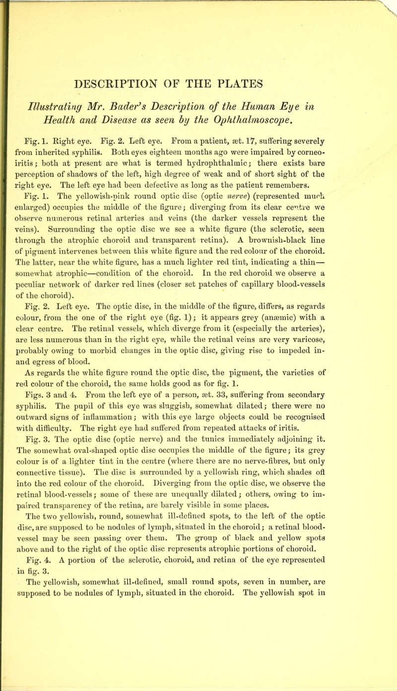 DESCRIPTION OF THE PLATES Illustrating Mr. Bader’s Description of the Human Eye in Health and Disease as seen by the Ophthalmoscope. Fig. 1. Right eye. Fig. 2. Left eye. From a patient, set. 17, suffering severely from inherited syphilis. Both eyes eighteen months ago were impaired by corneo- iritis j both at present are what is termed hydrophthalmic; there exists bare perception of shadows of the left, high degree of weak and of short sight of the right eye. The left eye had been defective as long as the patient remembers. Fig. 1. The yellowish-pink round optic disc (optic nerve) (represented much enlarged) occupies the middle of the figure; diverging from its clear centre we observe numerous retinal arteries and veins (the darker vessels represent the veins). Surrounding the optic disc we see a white figure (the sclerotic, seen through the atrophic choroid and transparent retina). A brownish-black line of pigment intervenes between this white figure and the red colour of the choroid. The latter, near the white figure, has a much lighter red tint, indicating a thin— somewhat atrophic—condition of the choroid. In the red choroid we observe a peculiar network of darker red lines (closer set patches of capillary blood-vessels of the choroid). Fig. 2. Left eye. The optic disc, in the middle of the figure, differs, as regards colour, from the one of the right eye (fig. 1); it appears grey (anmmic) with a clear centre. The retinal vessels, which diverge from it (especially the arteries), are less numerous than in the right eye, while the retinal veins are very varicose, probably owing to morbid changes in the optic disc, giving rise to impeded in- and egress of blood. As regards the white figure round the optic disc, the pigment, the varieties of red colour of the choroid, the same holds good as for fig. 1. Figs. 3 and 4. From the left eye of a person, set. 33, suffering from secondary syphilis. The pupil of this eye was sluggish, somewhat dilated; there were no outward signs of inflammation; with this eye large objects could he recognised with difficulty. The right eye had suffered from repeated attacks of iritis. Fig. 3. The optic disc (optic nerve) and the tunics immediately adjoining it. The somewhat oval-shaped optic disc occupies the middle of the figure; its grey colour is of a lighter tint in the centre (where there are no nerve-fibres, but only connective tissue). The disc is surrounded by a yellowish ring, which shades off into the red colour of the choroid. Diverging from the optic disc, we observe the retinal blood-vessels; some of these are unequally dilated; others, owing to im- paired transparency of the retina, are barely visible in some places. The two yellowish, round, somewhat ill-defined spots, to the left of the optic disc, are supposed to be nodules of lymph, situated in the choroid; a retinal blood- vessel may be seen passing over them. The group of black and yellow spots above and to the right of the optic disc represents atrophic portions of choroid. Fig. 4. A portion of the sclerotic, choroid, and retina of the eye represented in fig. 3. The yellowish, somewhat ill-defined, small round spots, seven in number, are supposed to be nodules of lymph, situated in the choroid. The yellowish spot in