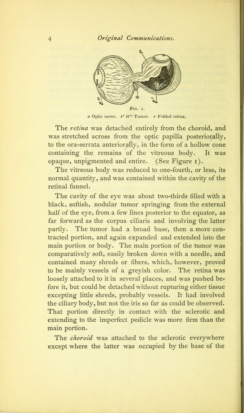 a Optic nerve. V tt” Tumor, r Folded retina. The retina was detached entirely from the choroid, and was stretched across from the optic papilla posteriorally, to the ora-serrata anteriorally, in the form of a hollow cone containing the remains of the vitreous body. It was opaque, unpigmented and entire. (See Figure i). The vitreous body was reduced to one-fourth, or less, its normal quantity, and was contained within the cavity of the retinal funnel. The cavity of the eye was about two-thirds filled with a black, softish, nodular tumor springing from the external half of the eye, from a few lines posterior to the equator, as far forward as the corpus ciliaris and involving the latter partly. The tumor had a broad base, then a more con- tracted portion, and again expanded and extended into the main portion or body. The main portion of the tumor was comparatively soft, easily broken down with a needle, and contained many shreds or fibers, which, however, proved to be mainly vessels of a greyish color. The retina was loosely attached to it in several places, and was pushed be- fore it, but could be detached without rupturing either tissue excepting little shreds, probably vessels. It had involved the ciliary body, but not the iris so far as could be observed. That portion directly in contact with the sclerotic and extending to the imperfect pedicle was more firm than the main portion. The choroid was attached to the sclerotic everywhere except where the latter was occupied by the base of the