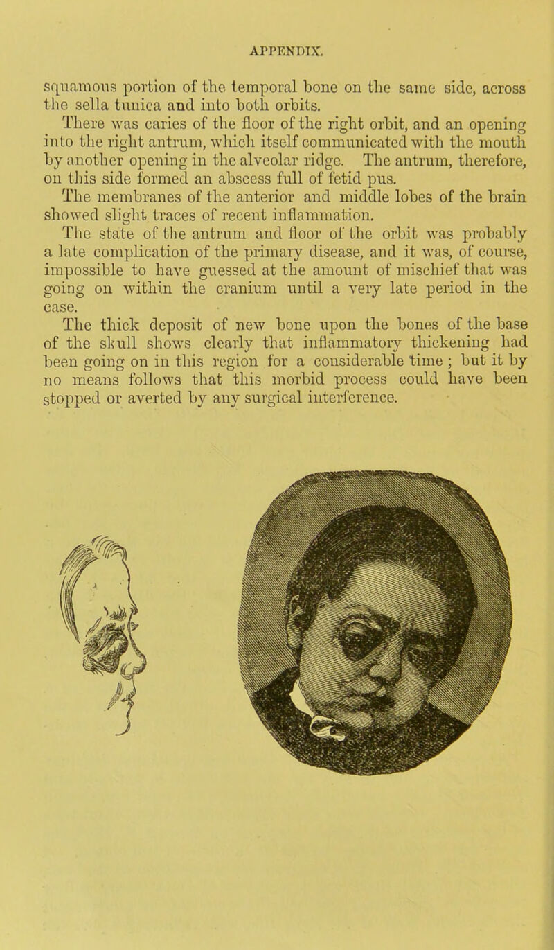 squamous portion of the temporal bone on the same side, across the sella tunica and into both orbits. There was caries of the floor of the right orbit, and an opening into the right antrum, which itself communicated with the mouth by another opening in the alveolar ridge. The antrum, therefore, on this side formed an abscess full of fetid pus. The membranes of the anterior and middle lobes of the brain showed slight traces of recent inflammation. The state of the antrum and floor of the orbit was probably a late complication of the primary disease, and it was, of course, impossible to have guessed at the amount of mischief that was going on within the cranium until a very late period in the case. The thick deposit of new bone upon the bones of the base of the skull shows clearly that inflammatory thickening had been going on in this region for a considerable time ; but it by no means follows that this morbid process could have been stopped or averted by any surgical interference.