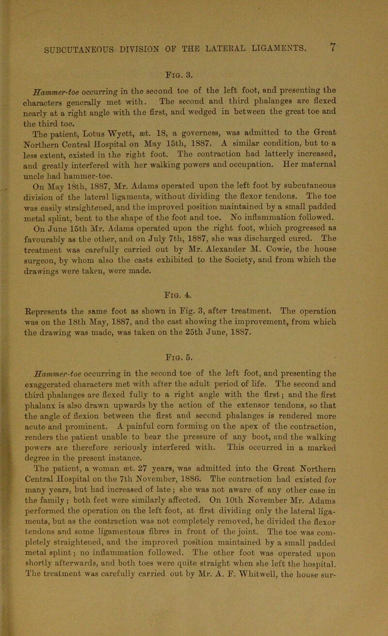 Fig. 3. Hammer-toe occurring in the second toe of the left foot, and presenting the characters generally met with. The second and third phalanges are flexed nearly at a right angle with the first, and wedged in between the great toe and the third toe. The patient, Lotus Wyett, a;t. 18, a governess, was admitted to the Great Northern Central Hospital on May 15th, 1887. A similar condition, but to a less extent, existed in the right foot. The contraction had latterly increased, and greatly interfered with her walking powers and occupation. Her maternal uncle had hammer-toe. On May 18th, 1887, Mr. Adams operated upon the left foot by subcutaneous division of the lateral ligaments, without dividing the flexor tendons. The toe was easily straightened, and the improved position maintained by a small padded metal splint, bent to the shape of the foot and toe. No inflammation followed. On June 15th Mr. Adams operated upon the right foot, which progressed as favourably as the other, and on July 7th, 1887, she was discharged cured. The treatment was carefully carried out by Mr. Alexander M. Cowie, the house surgeon, by whom also the casts exhibited to the Society, and from which the drawings were taken, were made. Fig. 4. Represents the same foot as shown in Fig. 3, after treatment. The operation -was on the 18th May, 1887, and the cast showing the improvement, from which the drawing was made, was taken on the 25th June, 1887. Fig. 5. Hammer-toe occurring in the second toe of the left foot, and presenting the exaggerated characters met with after the adult period of life. The second and third phalanges are flexed fully to a right angle with the first; and the first phalanx is also drawn upwards by the action of the extensor tendons, so that the angle of flexion between the first and second phalanges is rendered more acute and prominent. A painful corn forming on the apex of the contraction, renders the patient unable to bear the pressure of any boot, and the walking powers aio therefore seriously interfered with. This occurred in a marked degree in the present instance. The patient, a woman eet. 27 years, was admitted into the Great Northern Central Hospital on the 7th November, 1886. The contraction had existed for many years, but had increased of late; she was not aware of any other case in the family; both feet were similarly affected. On 10th November Mr. Adams performed the operation on the left foot, at first dividing only the lateral liga- ments, but as the contraction was not completely removed, he divided the flexor tendons and some ligamentous fibres in front of the joint. The toe was com- pletely straightened, and the improved position maintained by a small padded metal splint; no inflammation followed. The other foot was operated upon shortly afterwards, and both toes were quite straight when she left the hospital. The treatment was carefully carried out by Mr. A. F. Whitwell, the house sur-