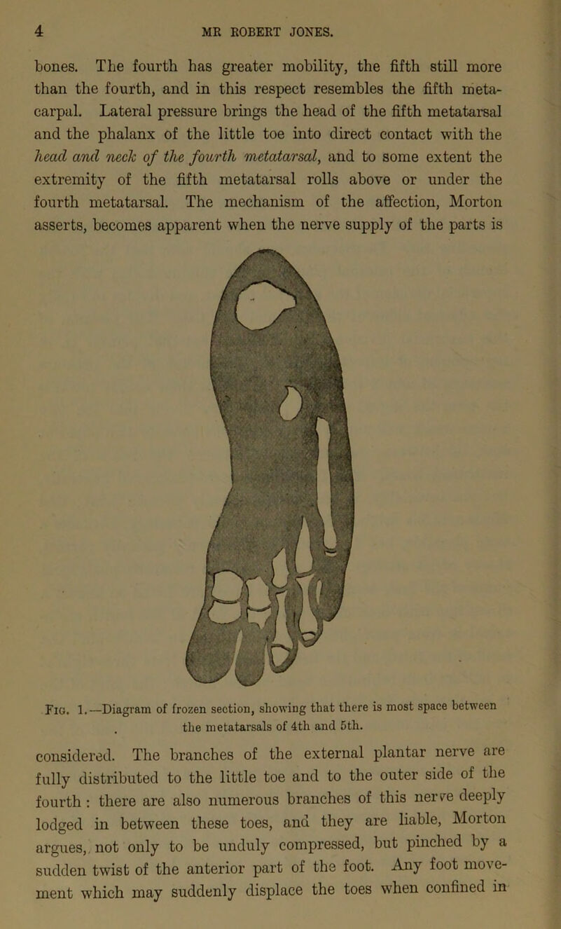 bones. The fourth has greater mobility, the fifth still more than the fourth, and in this respect resembles the fifth meta- carpal. Lateral pressure brings the head of the fifth metatarsal and the phalanx of the little toe into direct contact with the head and neck of the fourth metatarsal, and to some extent the extremity of the fifth metatarsal rolls above or under the fourth metatarsal. The mechanism of the affection, Morton asserts, becomes apparent when the nerve supply of the parts is Fio. 1.—Diagram of frozen section, showing that there is most space between the metatarsals of 4tli and 5tli. considered. The branches of the external plantar nerve aie fully distributed to the little toe and to the outer side of the fourth : there are also numerous branches of this nerve deeply lodged in between these toes, and they are liable, Morton argues,. not only to be unduly compressed, but pinched by a sudden twist of the anterior part of the foot. Any foot move- ment which may suddenly displace the toes when confined in