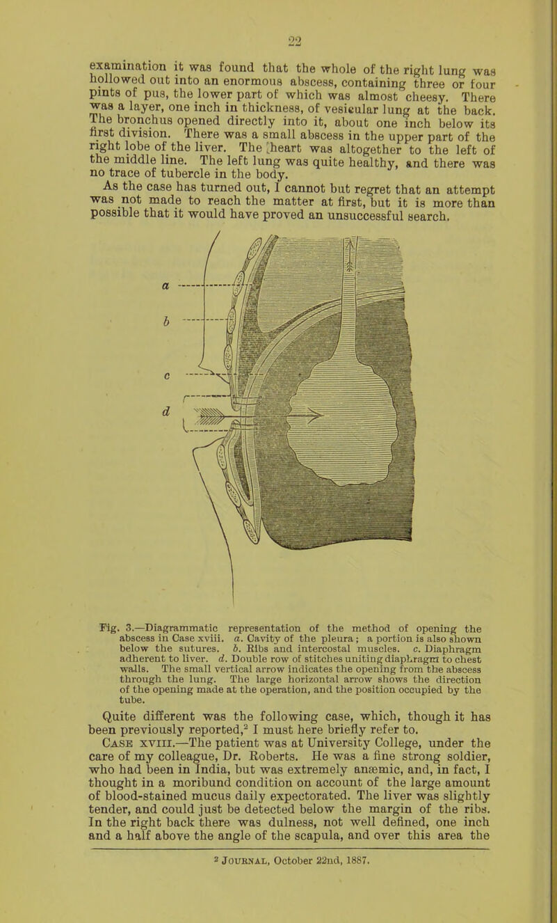 •>> examination it was found that the whole of the right lung was hollowed out into an enormous abscess, containing three or four pints of pus, the lower part of which was almost cheesy. There was a layer, one inch in thickness, of vesicular lung at the back. The bronchus opened directly into it, about one inch below its first division. There was a small abscess in the upper part of the right lobe of the liver. The-heart was altogether to the left of the middle line. The left lung was quite healthy, and there was no trace of tubercle in the body. As the case has turned out, 1 cannot but regret that an attempt was not made to reach the matter at first, but it is more than possible that it would have proved an unsuccessful search. Fig. 3.—Diagrammatic representation of the method of opening the abscess in Case xviii. a. Cavity of the pleura; a portion is also shown below the sutures, b. Bibs and intercostal muscles, c. Diaphragm adherent to liver, d. Double row of stitches uniting diaphragm to chest walls. The small vertical arrow indicates the opening from the abscess through the lung. The large horizontal arrow shows the direction of the opening made at the operation, and the position occupied by the tube. Quite different was the following case, which, though it has been previously reported,2 I must here briefly refer to. Case xviii.—The patient was at University College, under the care of my colleague, Dr. Roberts. He was a fine strong soldier, who had been in India, but was extremely anaemic, and, in fact, I thought in a moribund condition on account of the large amount of blood-stained mucus daily expectorated. The liver was slightly tender, and could just be detected below the margin of the ribs. In the right back there was dulness, not well defined, one inch and a half above the angle of the scapula, and over this area the