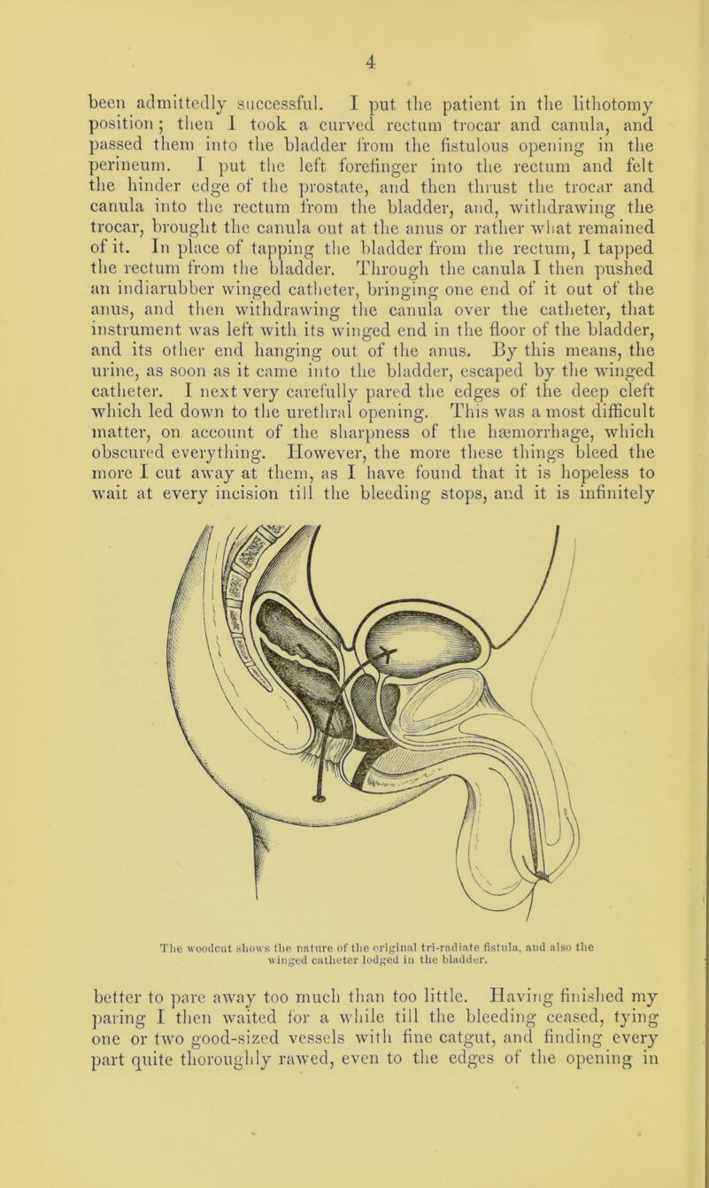 been admittedly successful. I put the patient in the lithotomy position; then 1 took a curved rectum trocar and canula, and passed them into the bladder from the fistulous opening in the perineum. I put the left forefinger into the rectum and felt the hinder edge of the prostate, and then thrust the trocar and canula into the rectum from the bladder, and, withdrawing the trocar, brought the canula out at the anus or rather what remained of it. In place of tapping the bladder from the rectum, I tapped the rectum from the bladder. Through the canula I then pushed an indiarubber winged catheter, bringing one end of it out of the anus, and then withdrawing the canula over the catheter, that instrument was left with its winged end in the floor of the bladder, and its other end hanging out of the anus. By this means, the urine, as soon as it came into the bladder, escaped by the winged catheter. I next very carefully pared the edges of the deep cleft which led down to the urethral opening. This was a most difficult matter, on account of the sharpness of the hamiorrhage, which obscured everything. However, the more these things bleed the more I cut away at them, as I have found that it is hopeless to wait at every incision till the bleeding stops, and it is infinitely The woodcut shows the nature of the original tri-radiate fistula, and also the winged catheter lodged in the bladder. better to pare away too much than too little. Having finished my paring I then waited tor a while till the bleeding ceased, tyin one or two good-sized vessels with fine catgut, and finding ever part quite thoroughly rawed, even to the edges of the opening in bo >-,