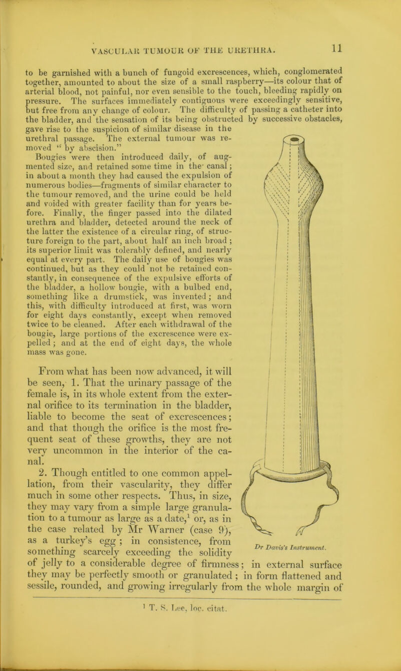 to be garnished with a bunch of fungoid excrescences, which, conglomerated together, amounted to about the size of a small raspberry—its colour that of arterial blood, not painful, nor even sensible to the touch, bleeding rapidly on pressure. The surfaces immediately contiguous were exceedingly sensitive, but free from any change of colour. The difficulty of passing a catheter into the bladder, and the sensation of its being obstructed by successive obstacles, gave rise to the suspicion of similar disease in the urethral passage. Tbe external tumour was re- moved “ by abscision.” Bougies were then introduced daily, of aug- mented size, and retained some time in the- canal; in about a month they had caused the expulsion of numerous bodies—fragments of similar character to the tumour removed, and the urine could be held and voided with greater facility than for years be- fore. Finally, the finger passed into the dilated urethra and bladder, detected around the neck of the latter the existence of a circular ring, of struc- ture foreign to the part, about half an inch broad ; its superior limit was tolerably defined, and nearly equal at every part. The daily use of bougies was continued, but as they could not be retained con- stantly, in consequence of the expulsive efforts of the bladder, a hollow bougie, with a bulbed end, something like a drumstick, was invented; and this, with difficulty introduced at first, was worn for eight days constantly, except when removed twice to be cleaned. After each withdrawal of the bougie, large portions of the excrescence were ex- pelled ; and at the end of eight days, the whole From what lias been now advanced, it will be seen, 1. That the urinary passage of the female is, in its whole extent from the exter- nal orifice to its termination in the bladder, liable to become the seat of excrescences; and that though the orifice is the most fre- quent seat of these growths, they are not very uncommon in the interior of the ca- nal. 2. Though entitled to one common appel- lation, from their vascularity, they differ much in some other respects. Thus, in size, they may vary from a simple large granula- tion to a tumour as large as a date,1 or, as in the case related by Mr Warner (case 9), as a turkey’s egg ; in consistence, from something scarcely exceeding the solidity °f jelly to a considerable degree of firmness; in external surface they may be perfectly smooth or granulated ; in form flattened and sessile, rounded, and growing irregularly from the whole margin of Dr Davis's Instrument. 1 T. S. Lee, Inc. citat.