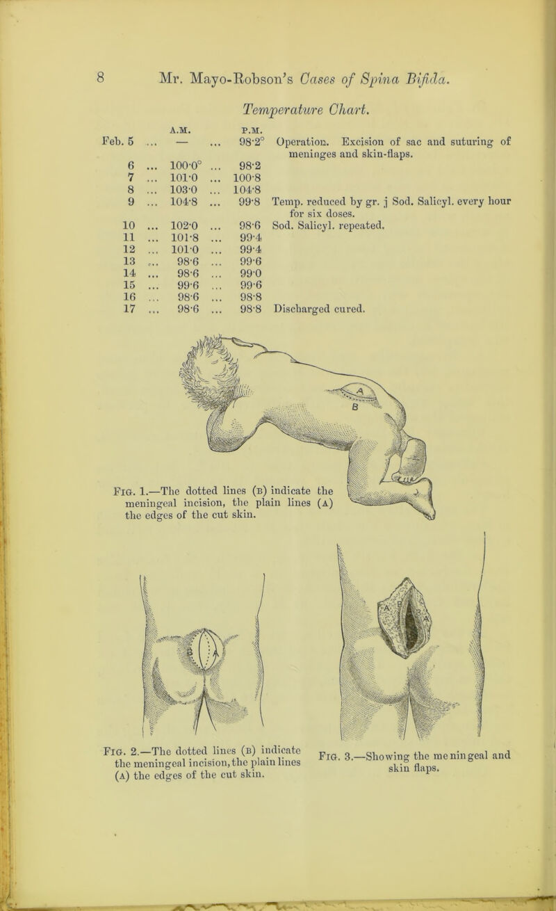 Temperature Chart. i.5 ... A.M. P.M. . 98-2° Operation. Excision 6 100'0° .. . 98-2 meninges and skin- 7 ... 101-0 .. . 100-8 8 ... 103-0 .. . 104-8 9 ... 104-8 .. . 99-8 Temp. reduced by gr. j 10 ... 102-0 .. . 98-6 for six doses. Sod. Salicyl. repeated. 11 ... 101-8 .. . 99-4 12 ... 101-0 .. . 99-4 13 r„ 98-6 .. . 99-6 14 ... 98-6 .. . 99-0 15 ... 99-6 .. . 99-6 16 ... 98-6 .. 98-8 17 ... 98-6 ., ,. 98-8 Discharged cured. Fig. 1.—The dotted lines (b) indicate the meningeal incision, the plain lines (a) the edges of the cut skin. Fig. 2.—The dotted lines (b) indicate the meningeal incision, the plain lines (a) the edges of the cut skin. Fig. 3.—Showing the meningeal and skin flaps.
