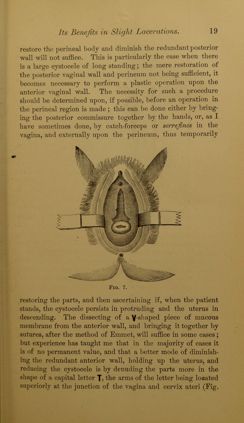 restore the perineal body and diminish the redundant posterior wall will not suffice. This is particularly the case when there is a large cystocele of long standing; the mere restoration of the posterior vaginal wall and perineum not being sufficient, it becomes necessary to perform a plastic operation upon the anterior vaginal wall. The necessity for such a procedure should be determined upon, if possible, before an operation in the perineal region is made ; this can be done either by bring- ing the posterior commissure together by the hands, or, as I have sometimes done, by catch-forceps or serrefines in the vagina, and externally upon the perineum, thus temporarily Fig. 7. restoring the parts, and then ascertaining if, when the patient stands, the cystocele persists in protruding and the uterus in descending. The dissecting of a Y-shaped piece of mucous membrane from the anterior wall, and bringing it together by sutures, after the method of Emmet, will suffice in some cases; but experience has taught me that in the majority of cases it is of no permanent value, and that a better mode of diminish- ing the redundant anterior wall, holding up the uterus, and reducing the cystocele is by denuding the parts more in the shape of a capital letter Tj the arms of the letter being looated superiorly at the junction of the vagina and cervix uteri (Fig.