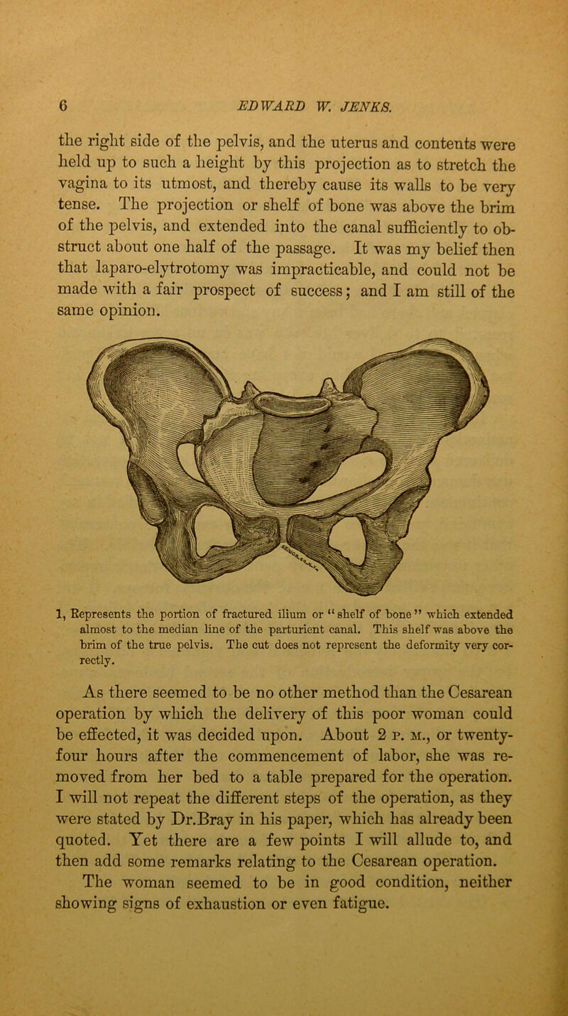 the right side of the pelvis, and the uterus and contents were held up to such a height by this projection as to stretch the vagina to its utmost, and thereby cause its walls to be very tense. The projection or shelf of bone was above the brim of the pelvis, and extended into the canal sufficiently to ob- struct about one half of the passage. It was my belief then that laparo-elytrotomy was impracticable, and could not be made with a fair prospect of success; and I am still of the same opinion. 1, Kepresents the portion of fractured ilium or “ shelf of hone ” which extended almost to the median line of the parturient canal. This shelf was above the brim of the true pelvis. The cut does not represent the deformity very cor- rectly. As there seemed to be no other method than the Cesarean operation by which the delivery of this poor woman could be effected, it was decided upon. About 2 p. m., or twenty- four hours after the commencement of labor, she was re- moved from her bed to a table prepared for the operation. I will not repeat the different steps of the operation, as they were stated by Dr.Bray in his paper, which has already been quoted. Yet there are a few points I will allude to, and then add some remarks relating to the Cesarean operation. The woman seemed to be in good condition, neither showing signs of exhaustion or even fatigue.