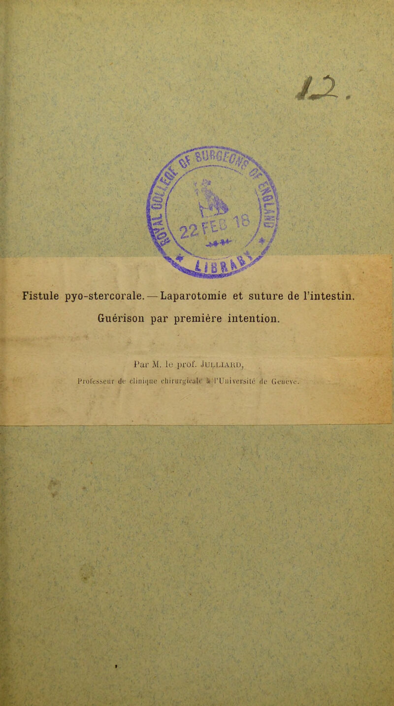 IX. Fistule pyo-stercorale. — Laparotomie et suture de l’intestin. Guérison par première intention. . A..' \ -, - v' •' . • ? ■ w. 4 ■ ■ 1 ■ > • >•. v .. ■ ' Par M. le prof. Julliaro, Professeur de cl i n i<| ne ch i ni cgi cuir i< l’Université de Genève. ' n» ; \ . . .v . . •